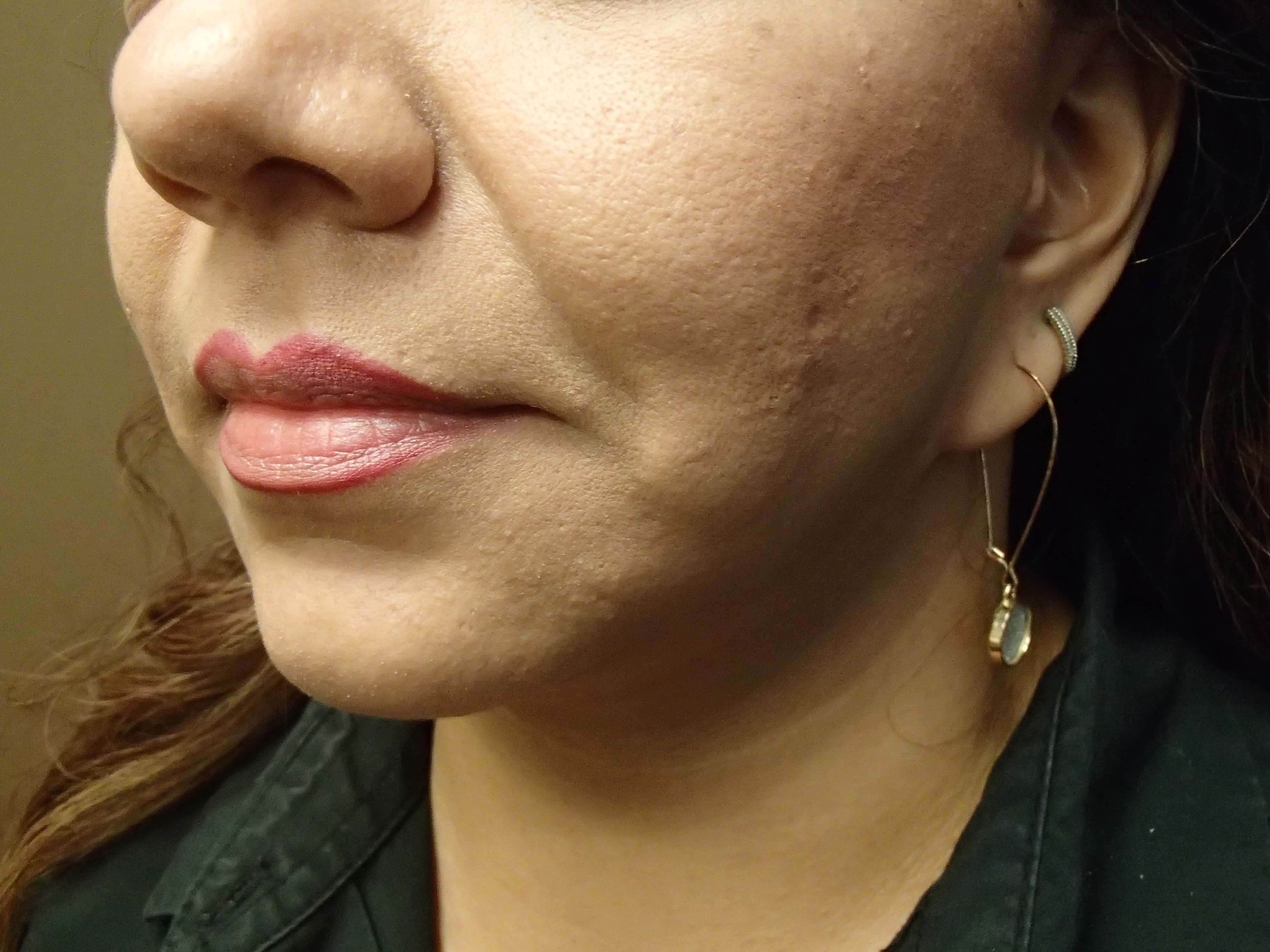 Necklift After