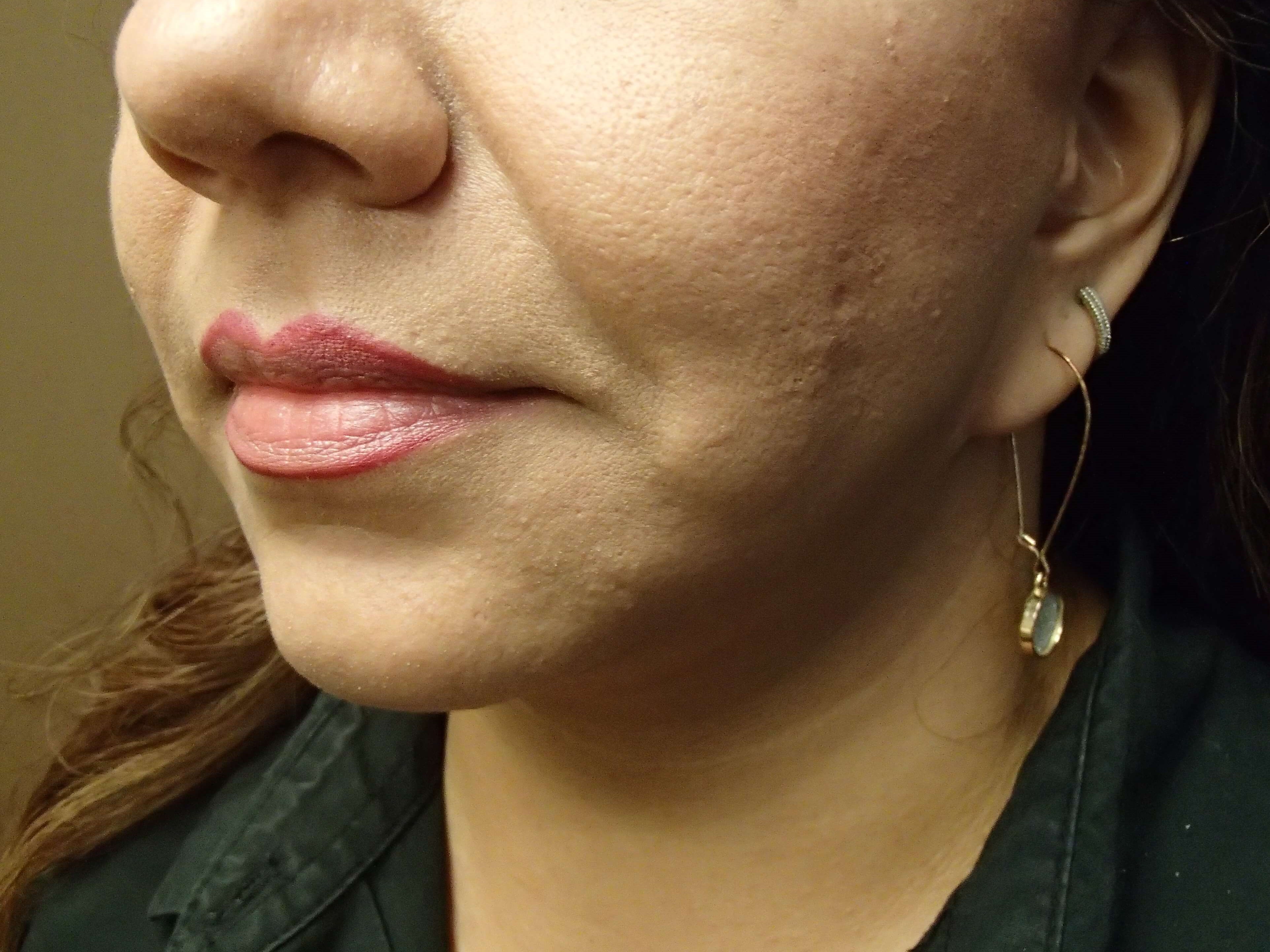Necklift After