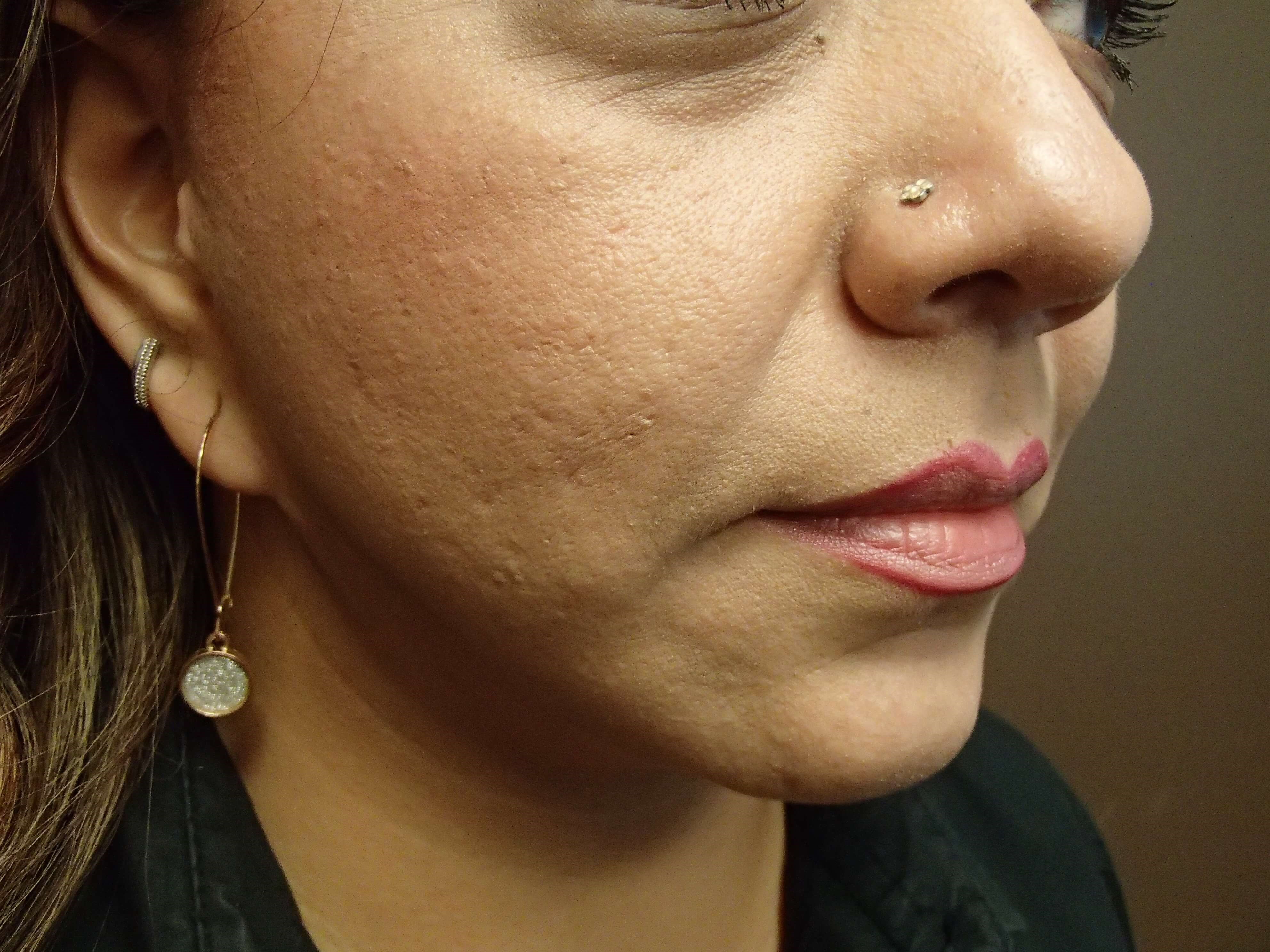 Necklift After