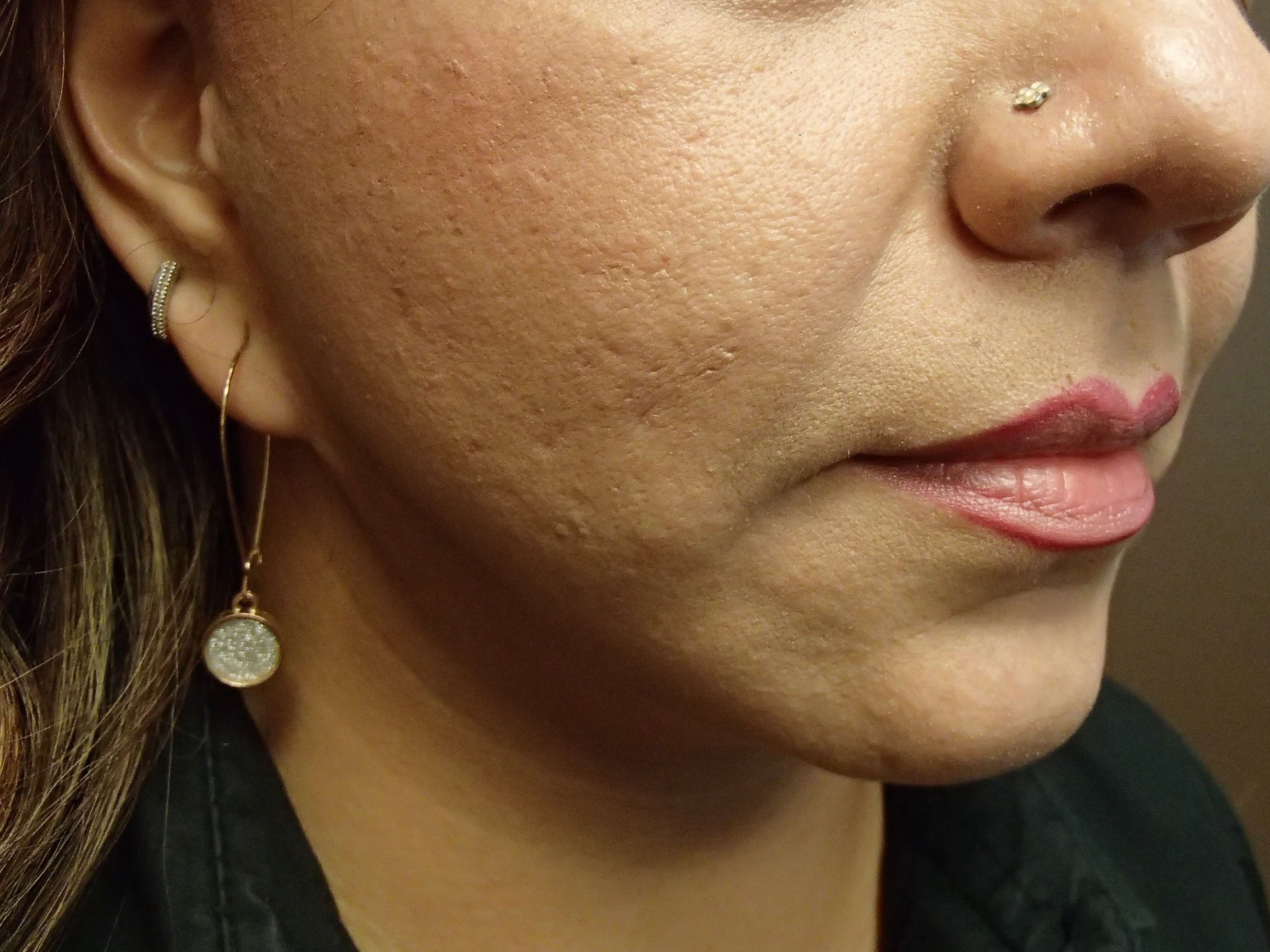 Necklift After