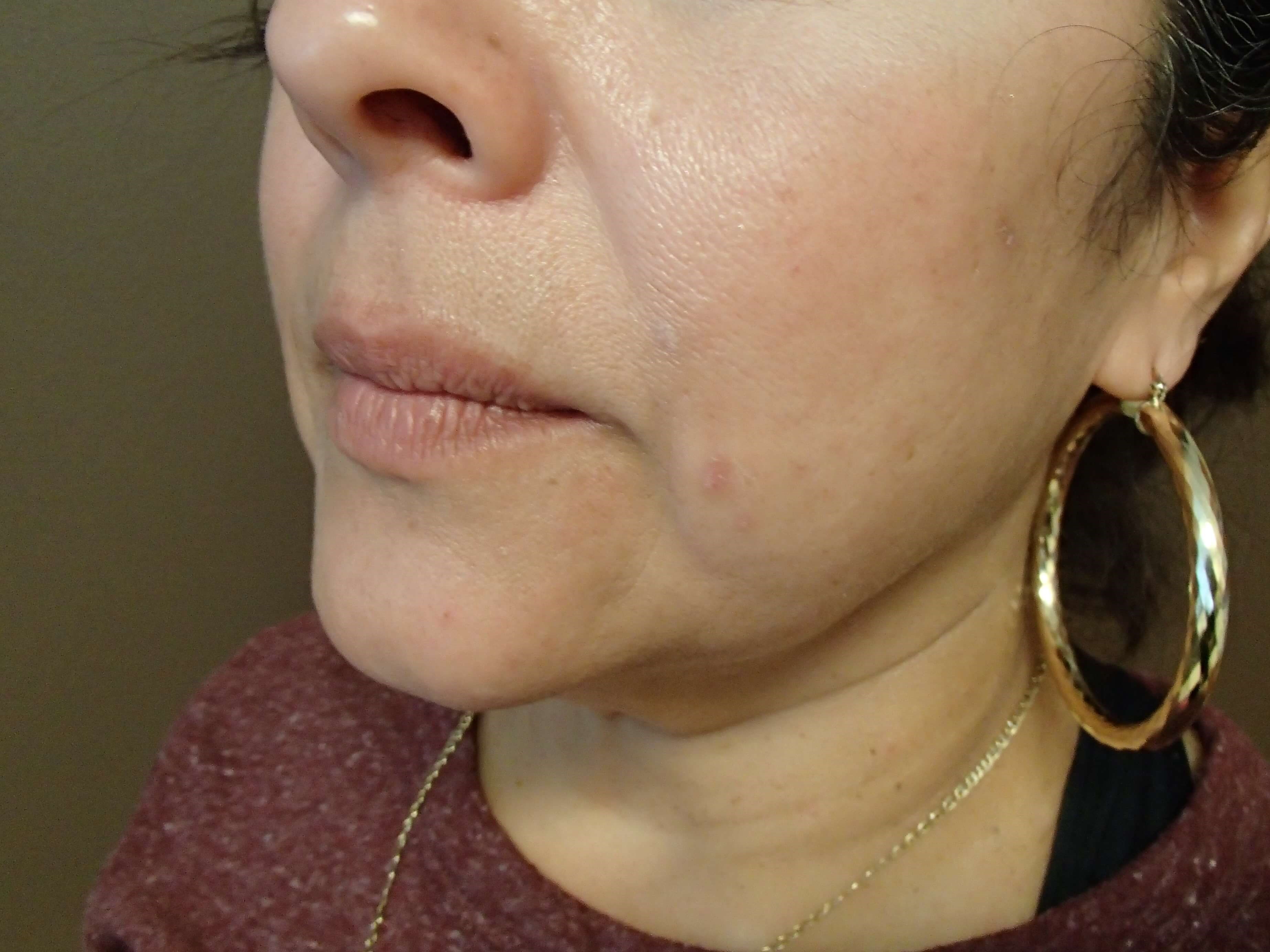 Necklift Before
