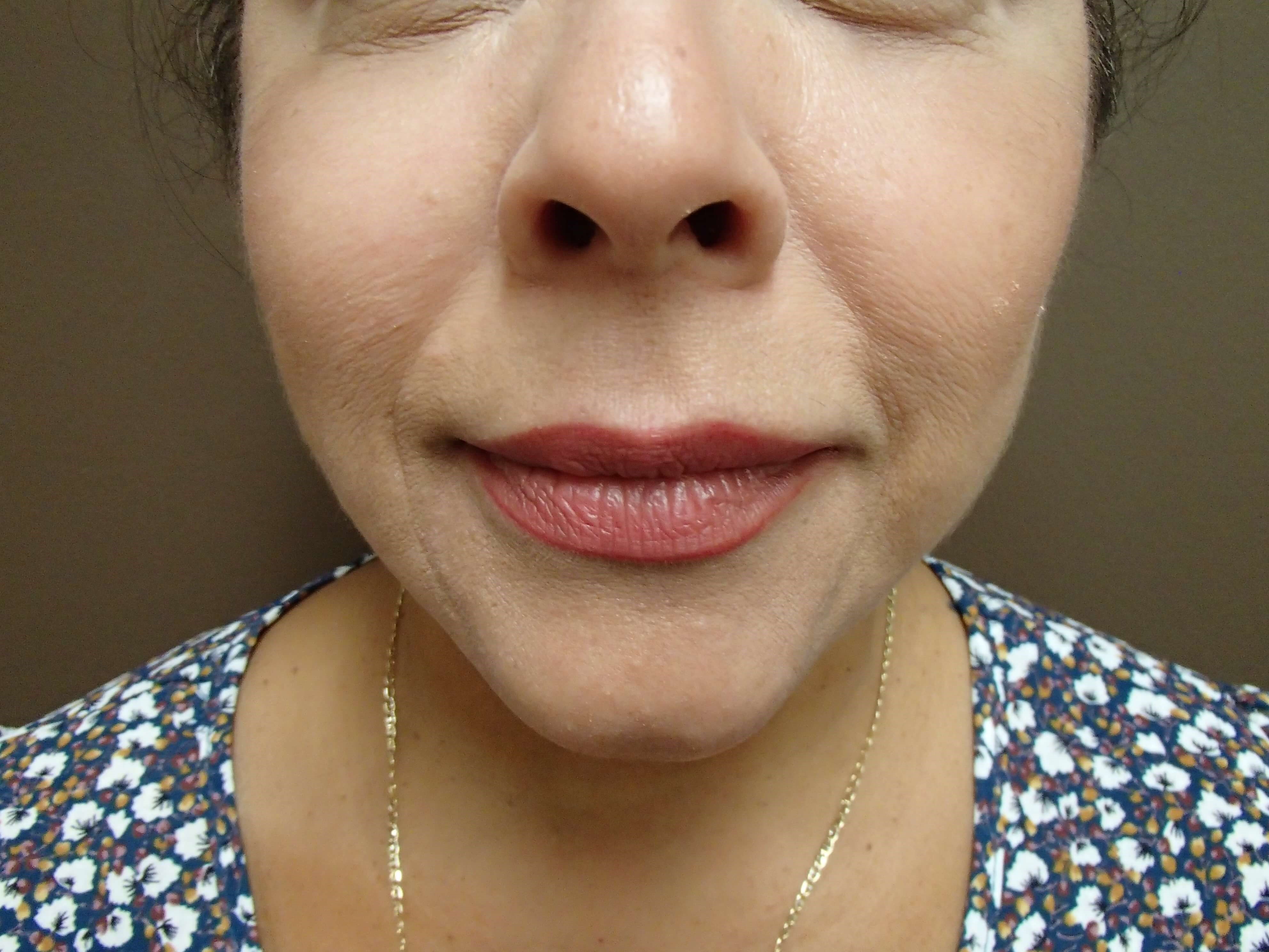 Necklift After