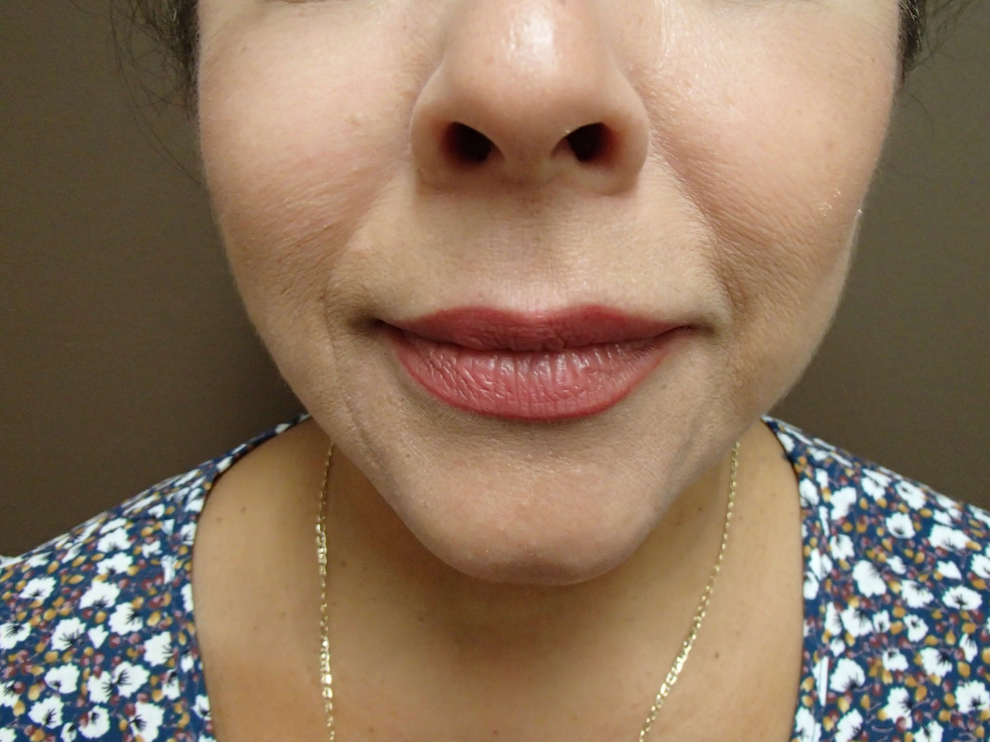 Necklift After