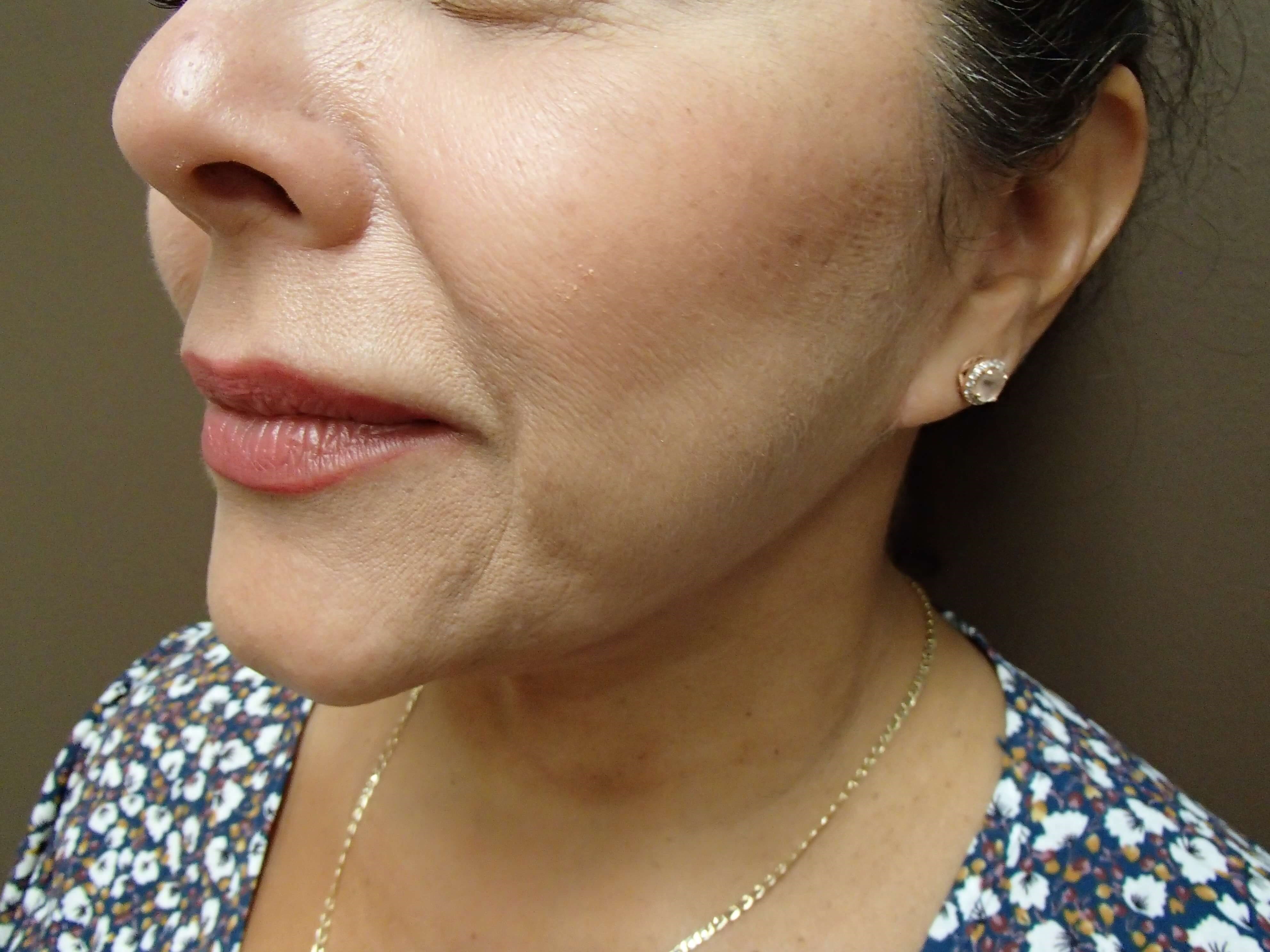 Necklift After