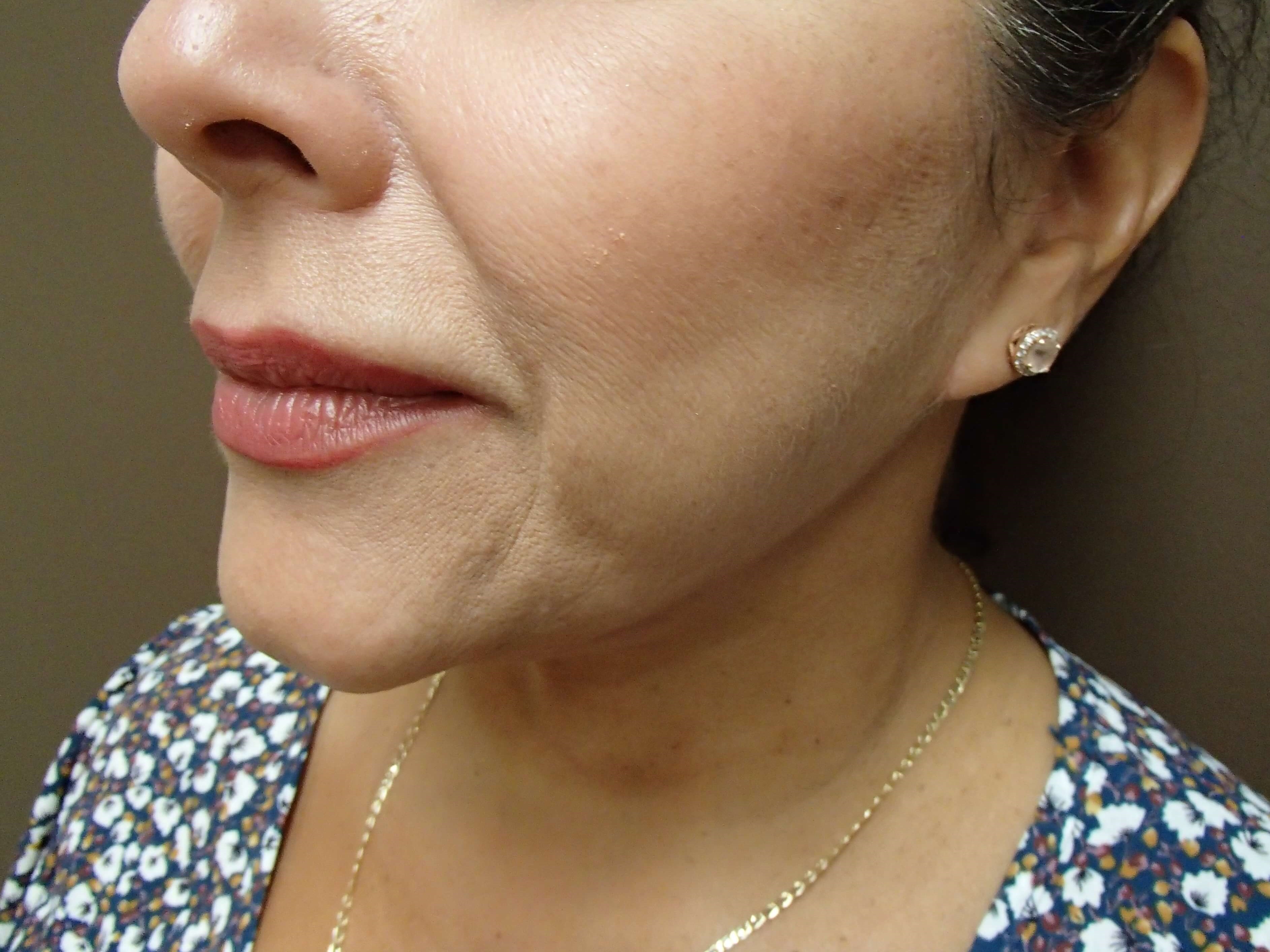 Necklift After