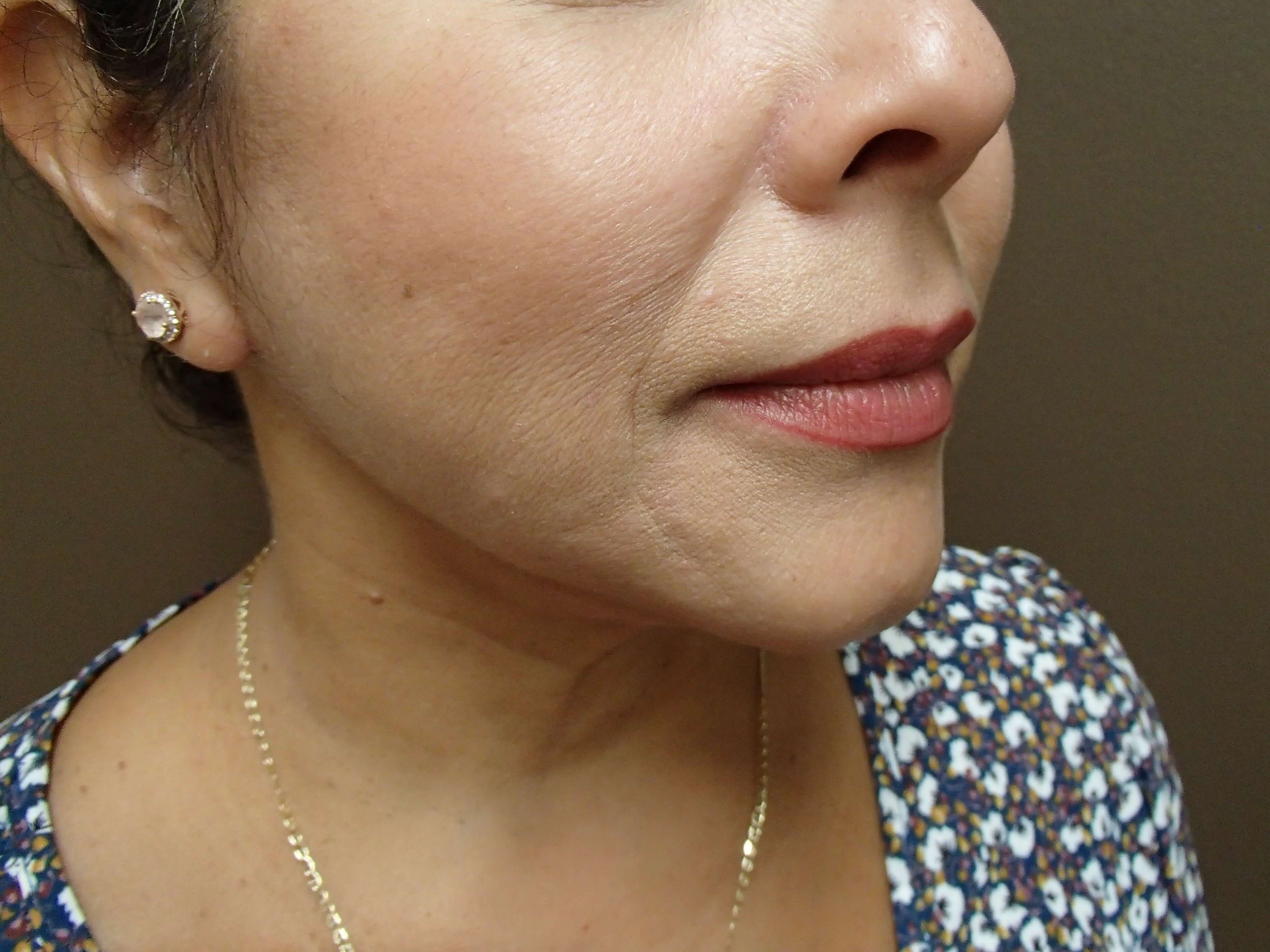 Necklift After