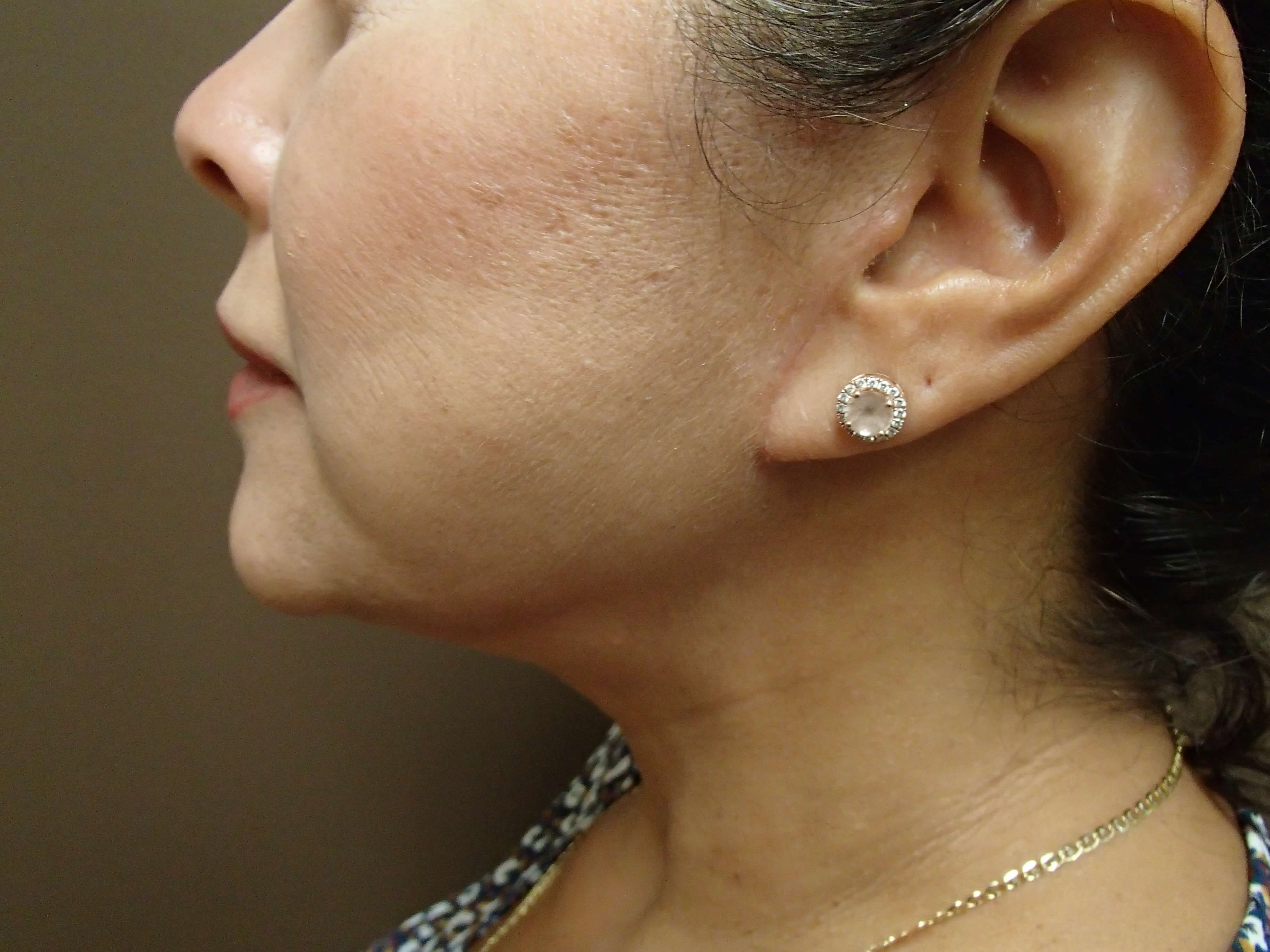 Necklift After
