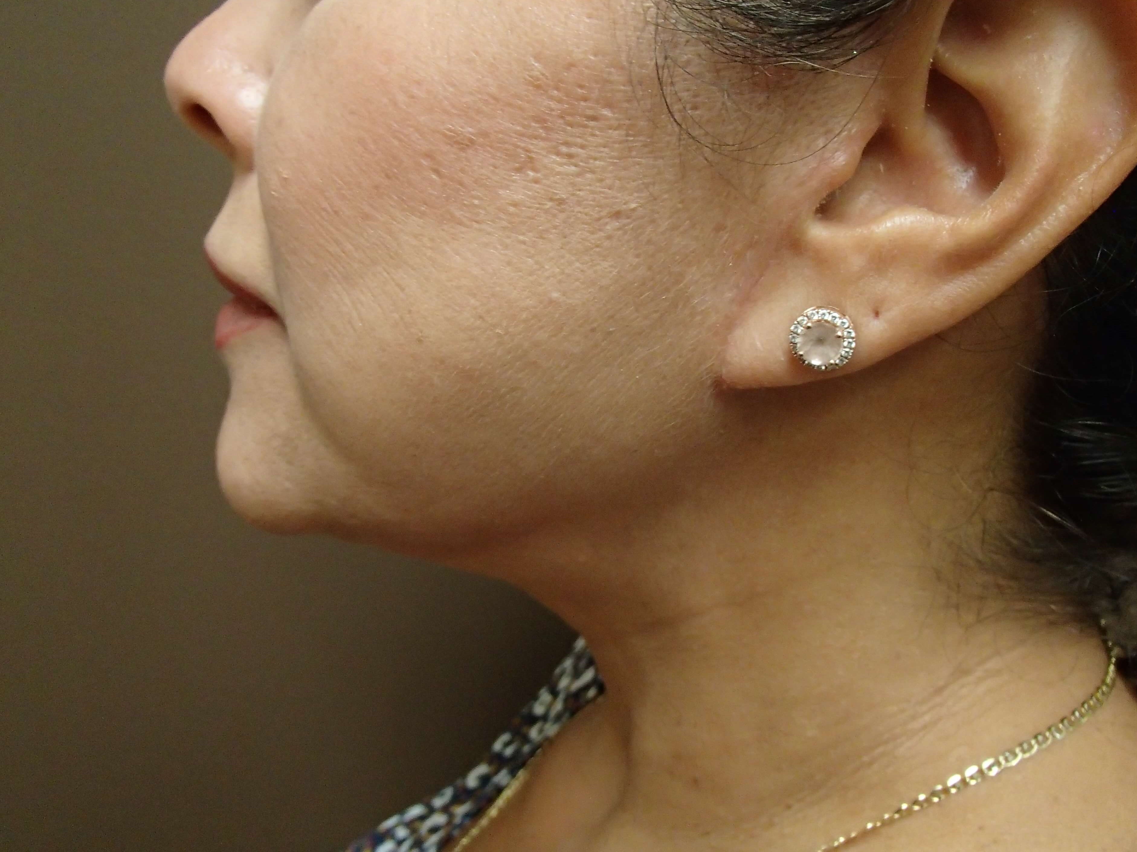 Necklift After