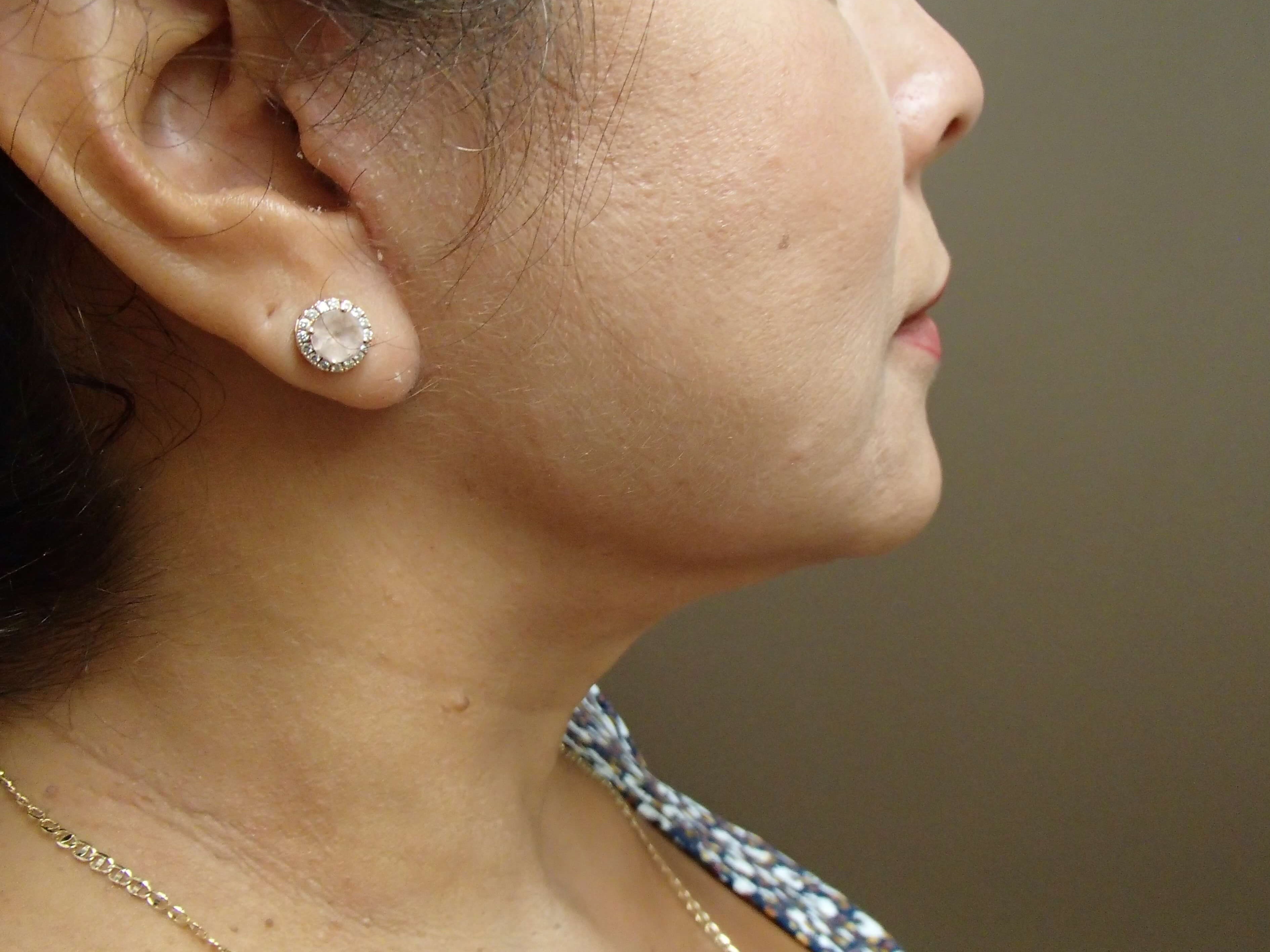 Necklift After
