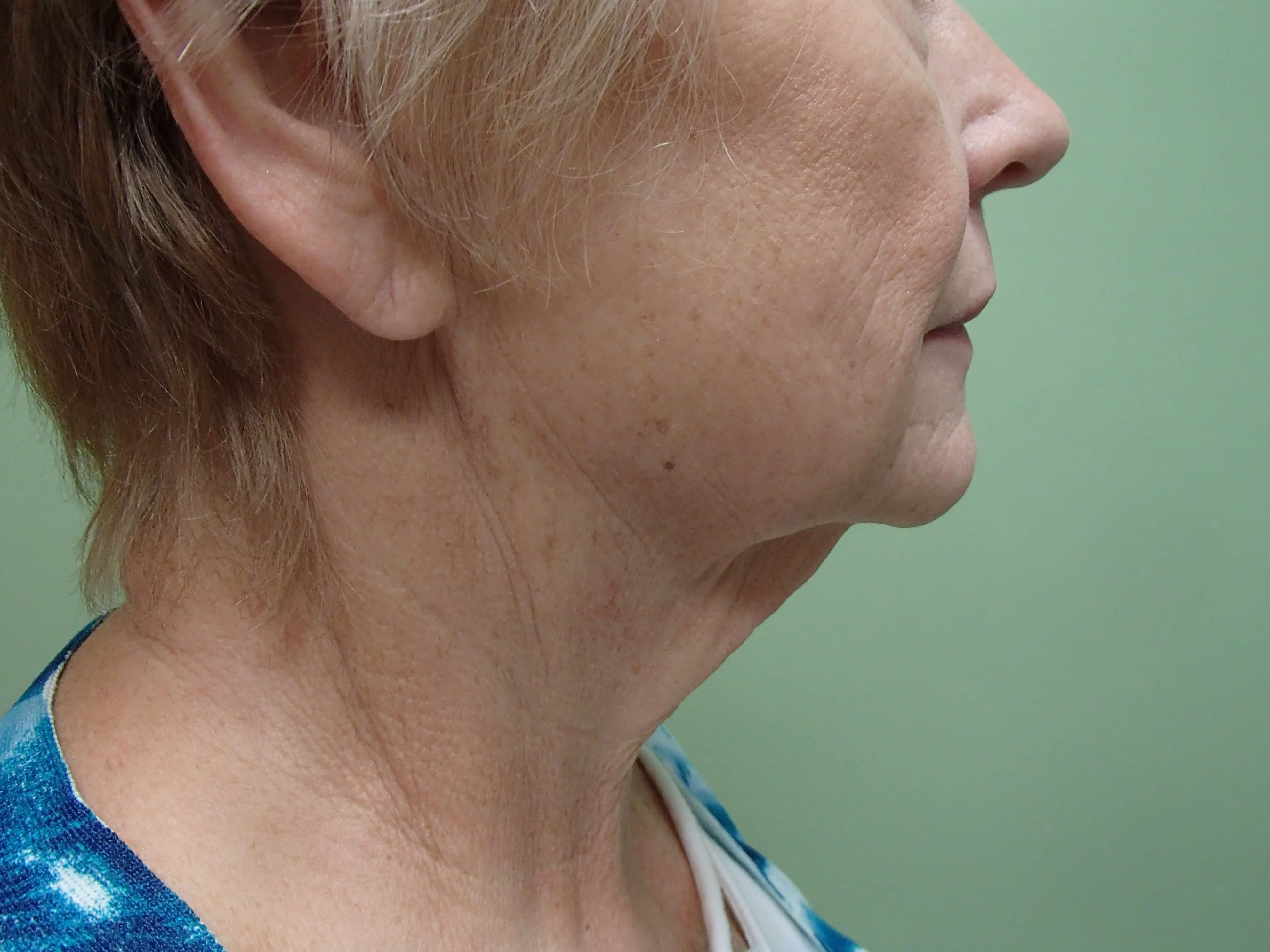 Faclift/Necklift Before