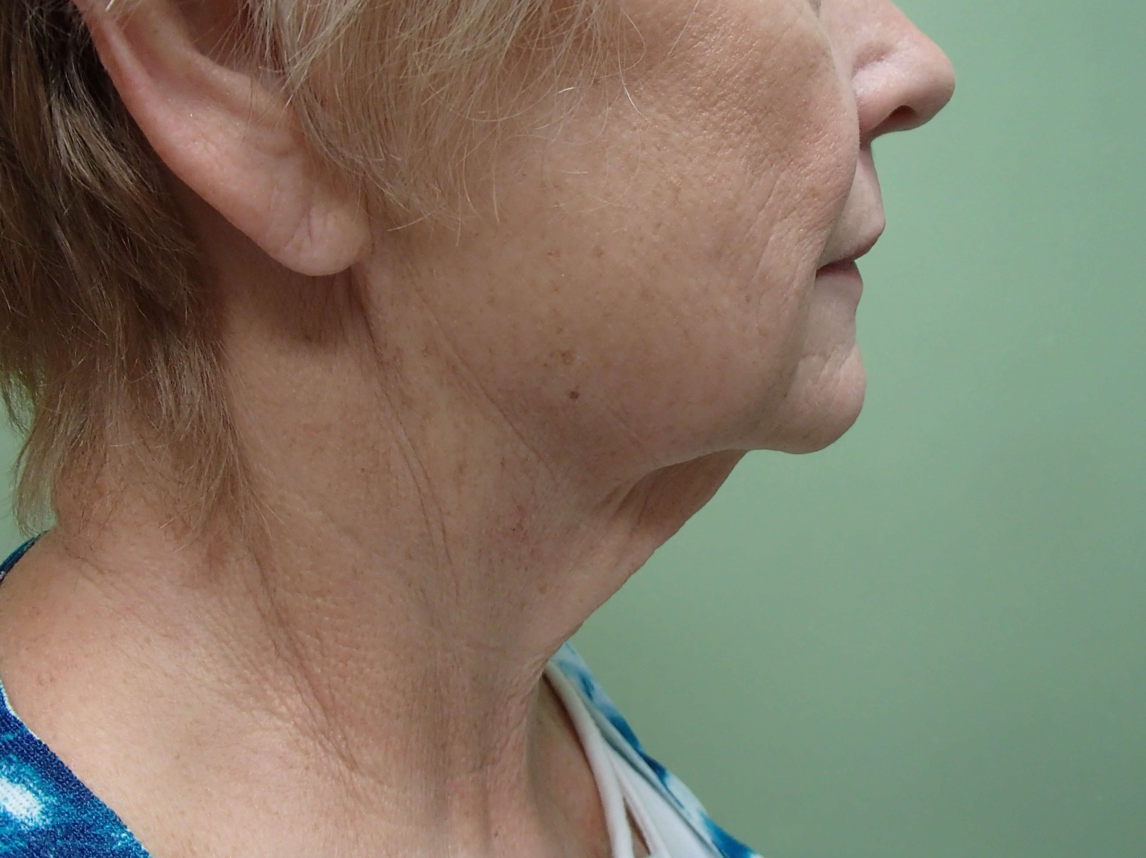 Faclift/Necklift Before