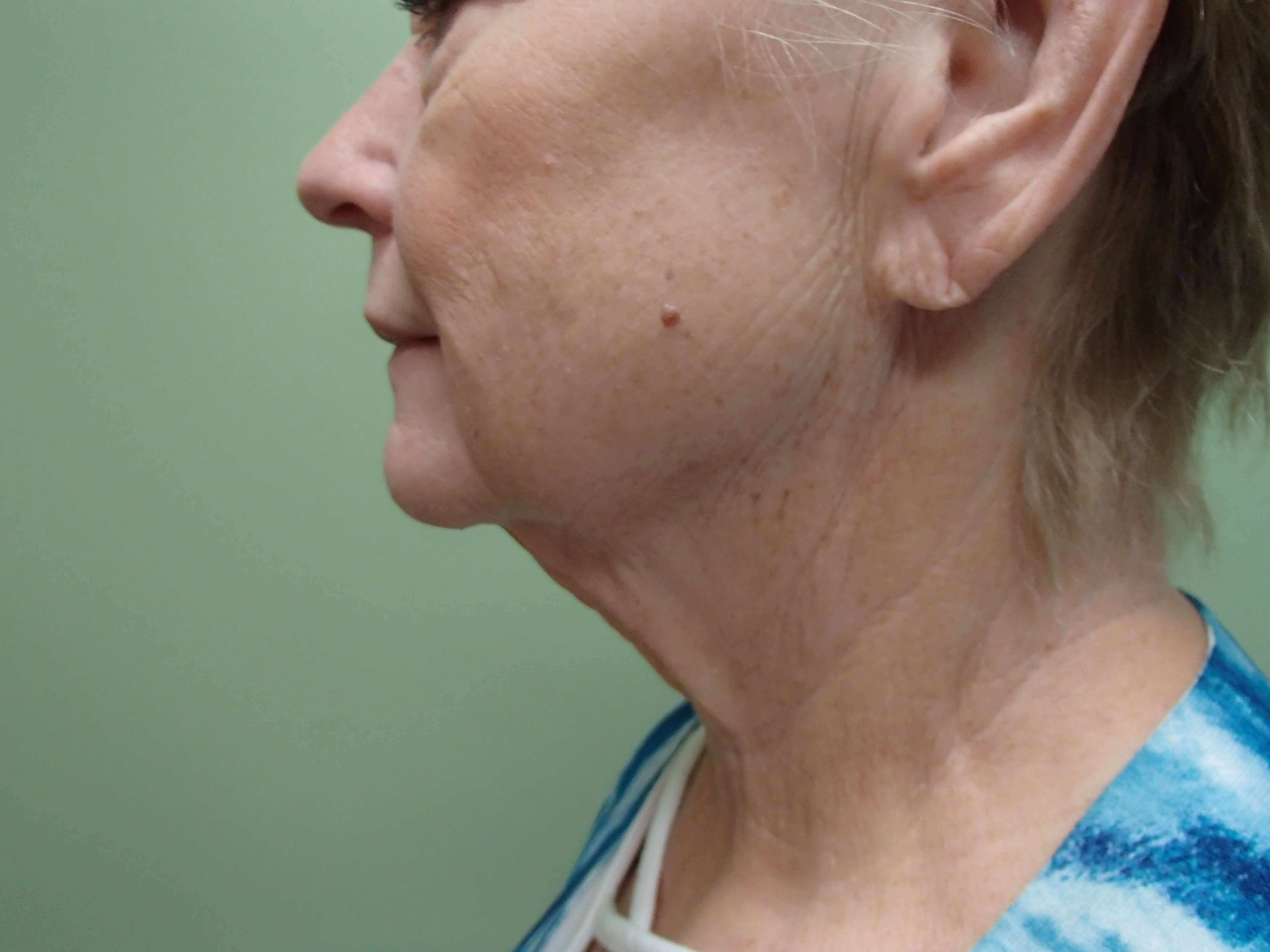 Faclift/Necklift Before