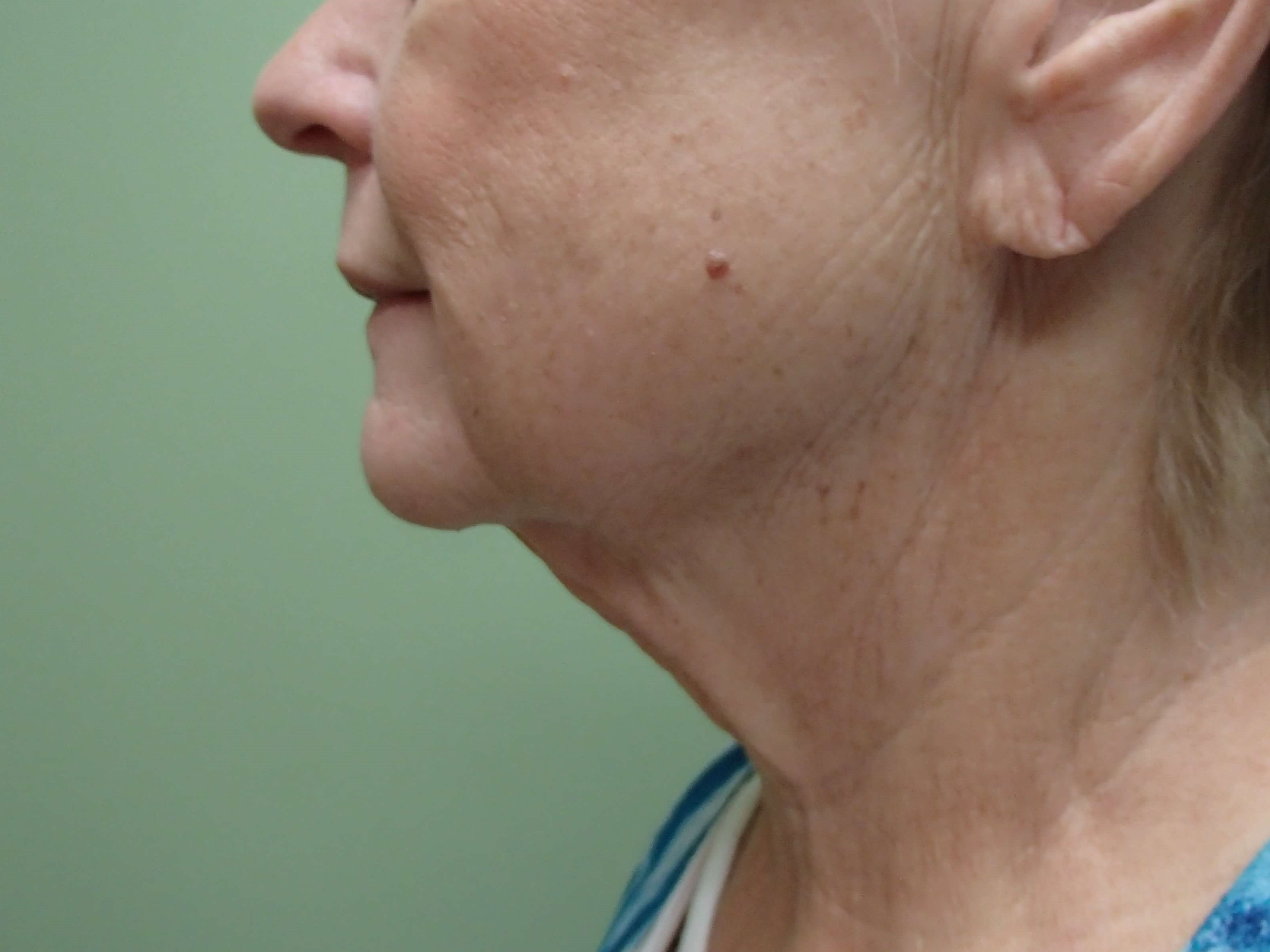 Faclift/Necklift Before