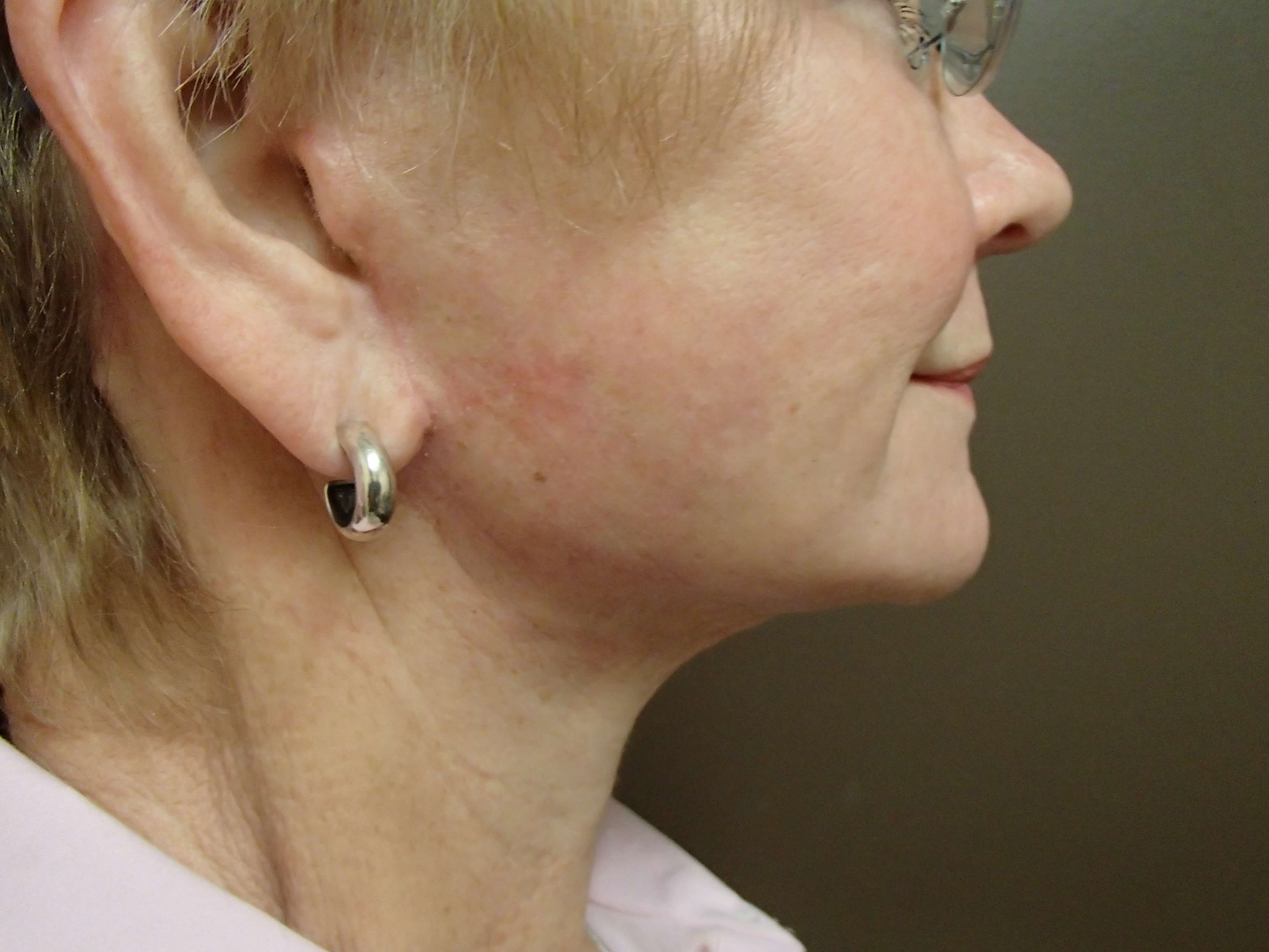 Faclift/Necklift After