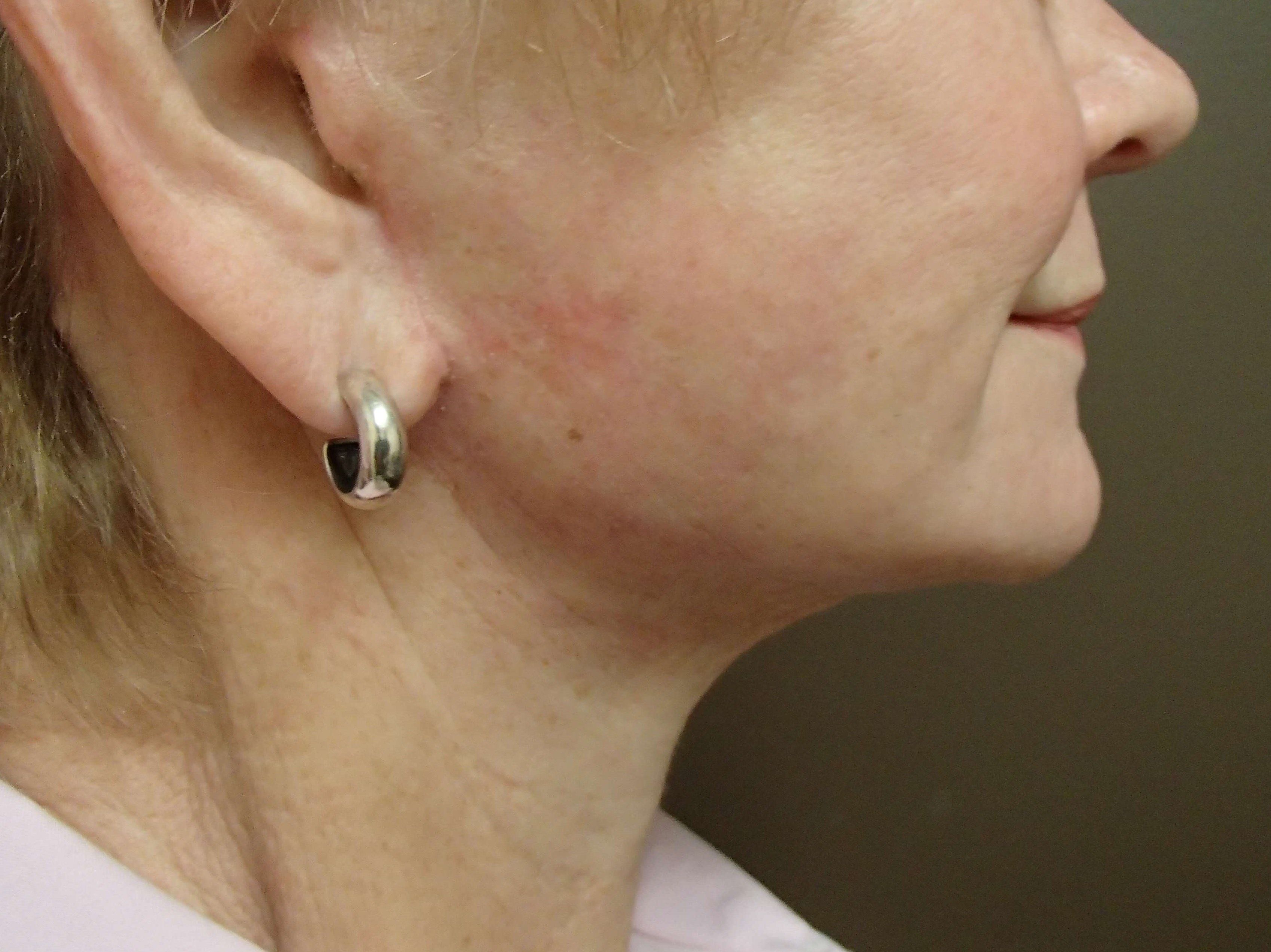 Faclift/Necklift After