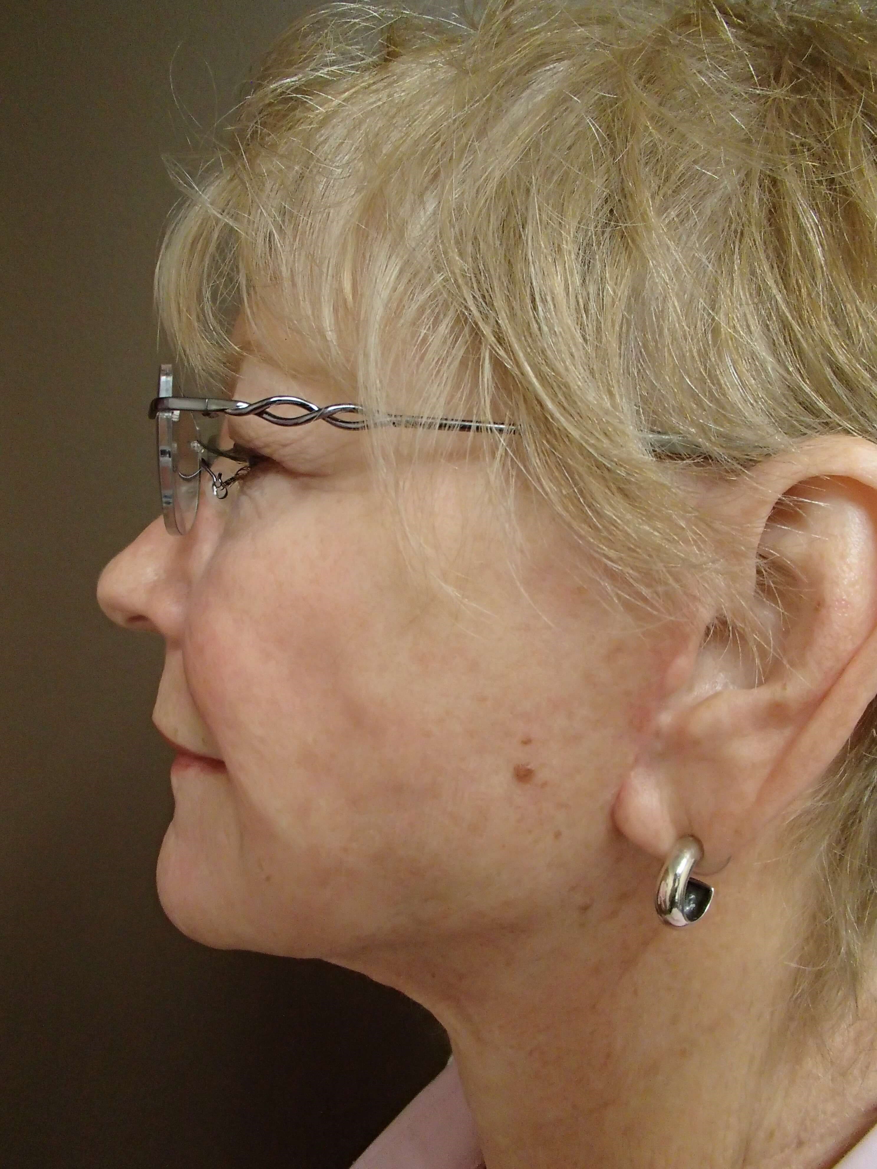 Faclift/Necklift After