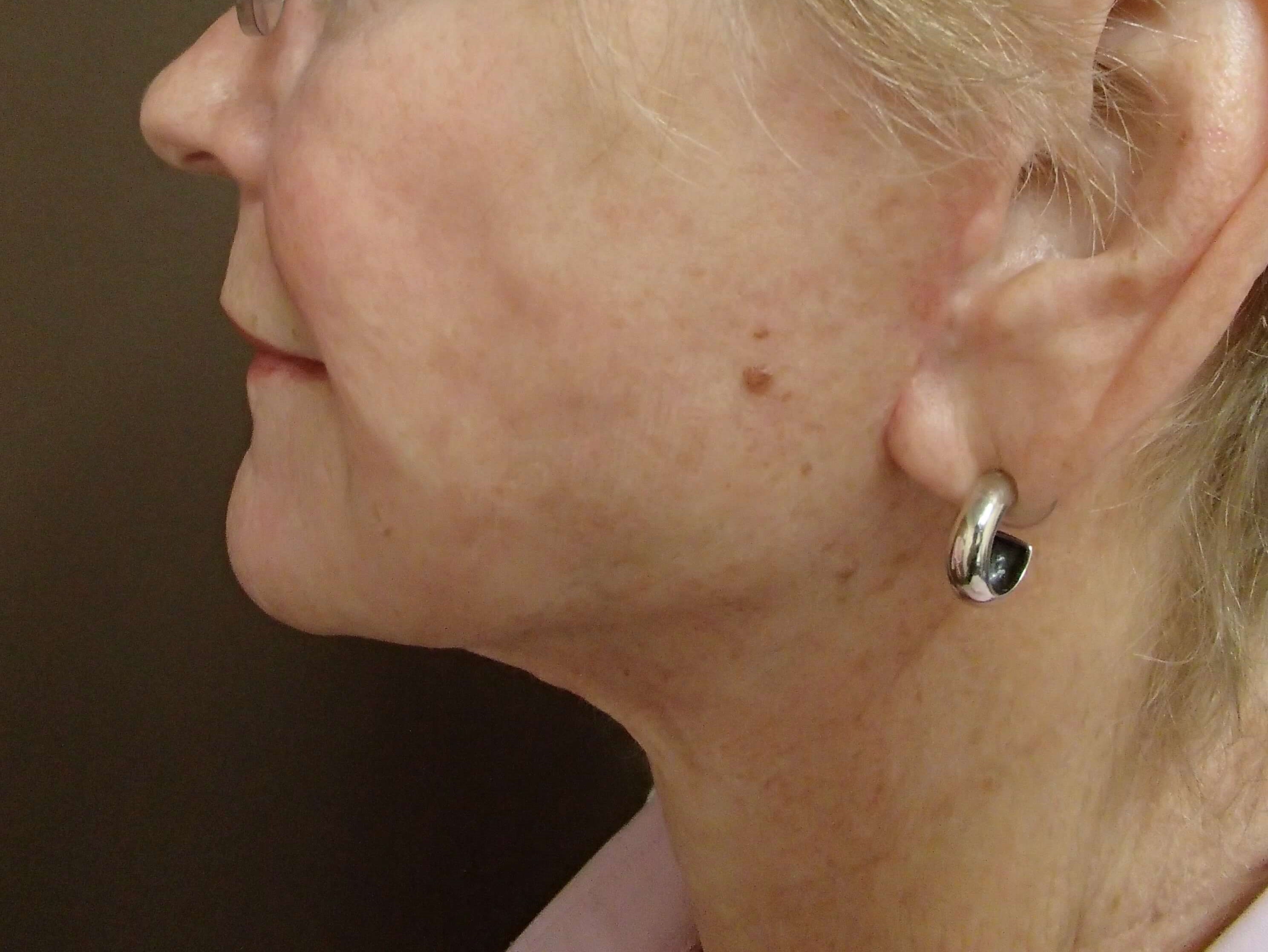 Faclift/Necklift After