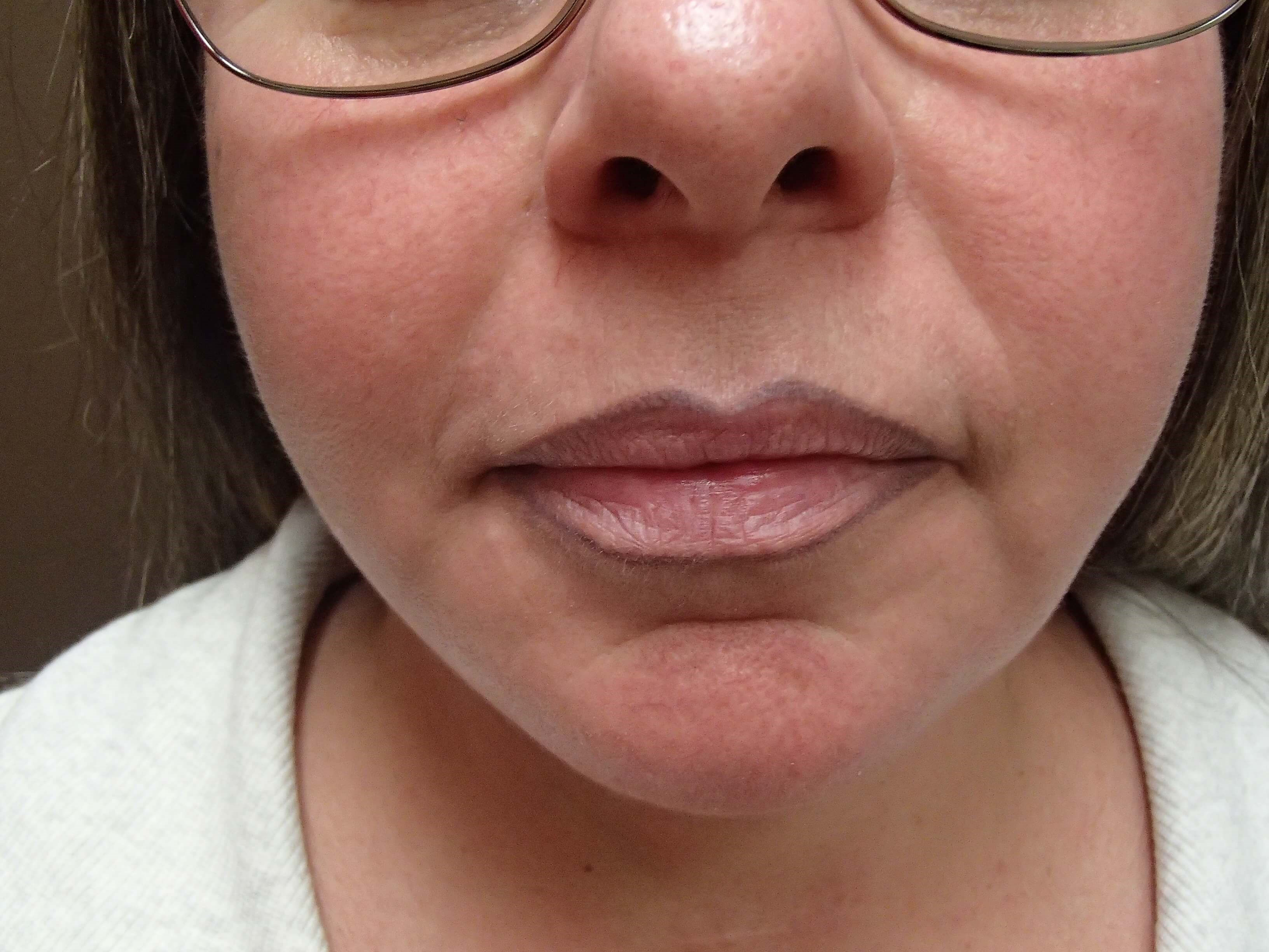 Necklift After