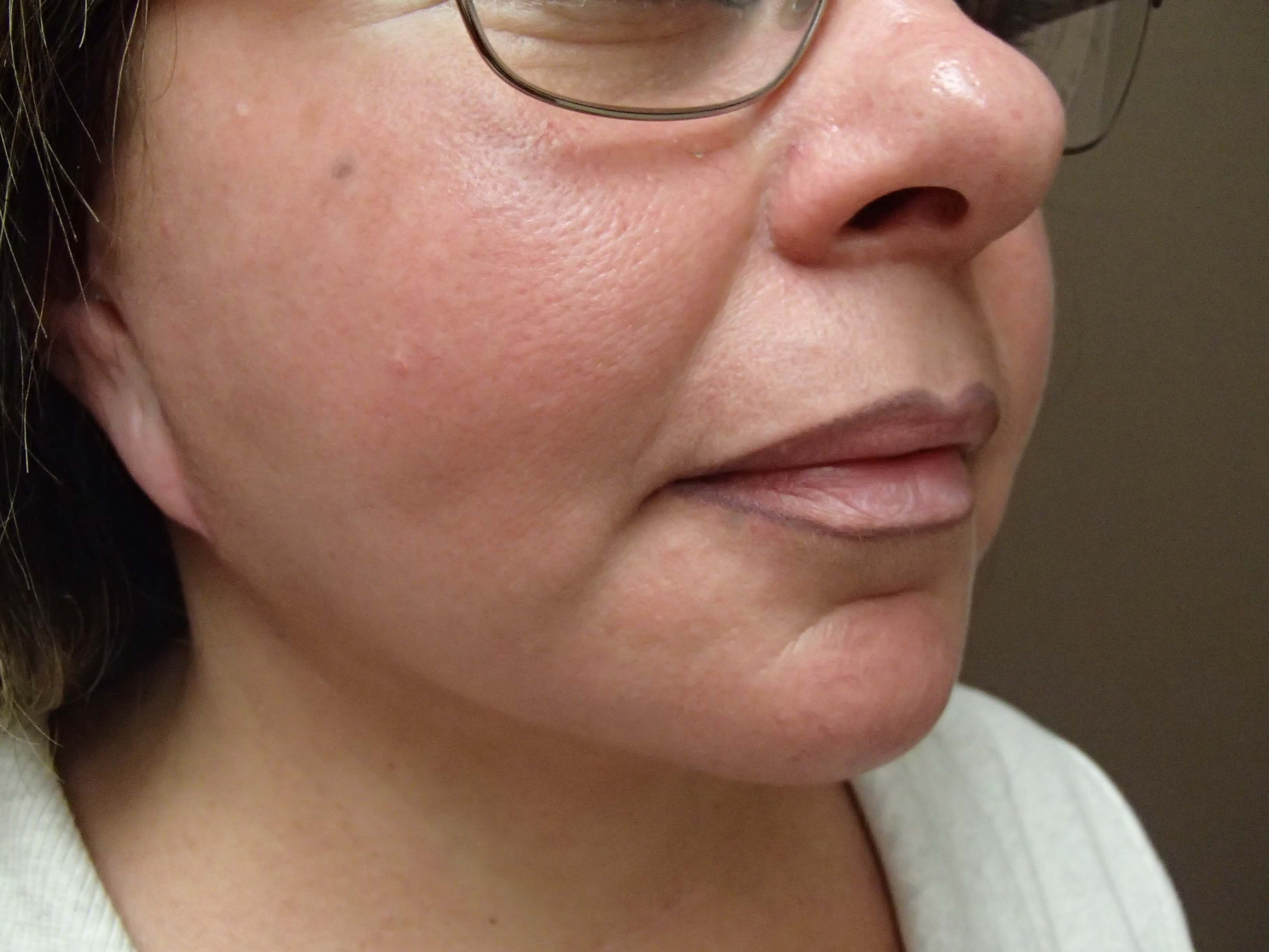 Necklift After
