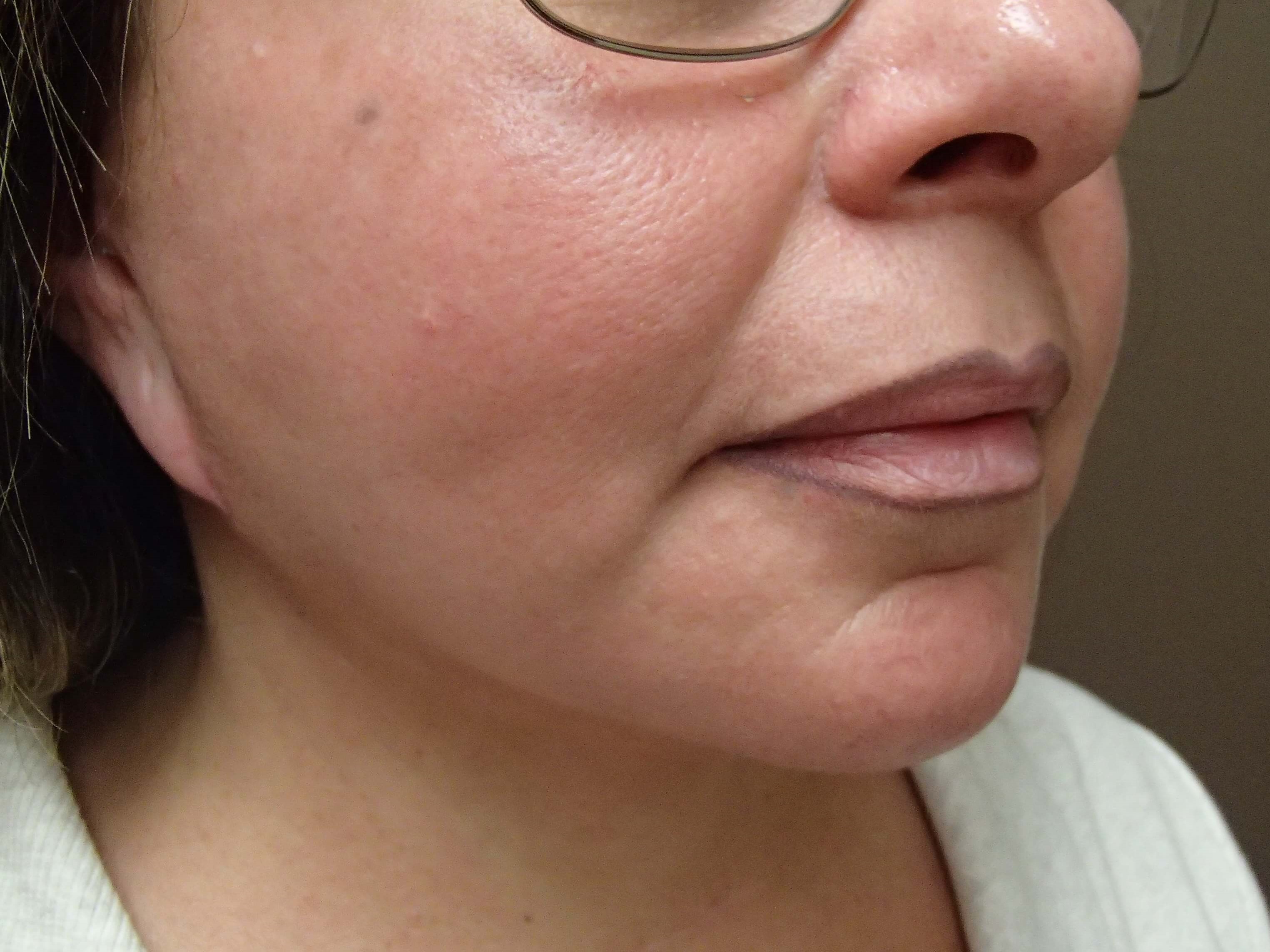 Necklift After