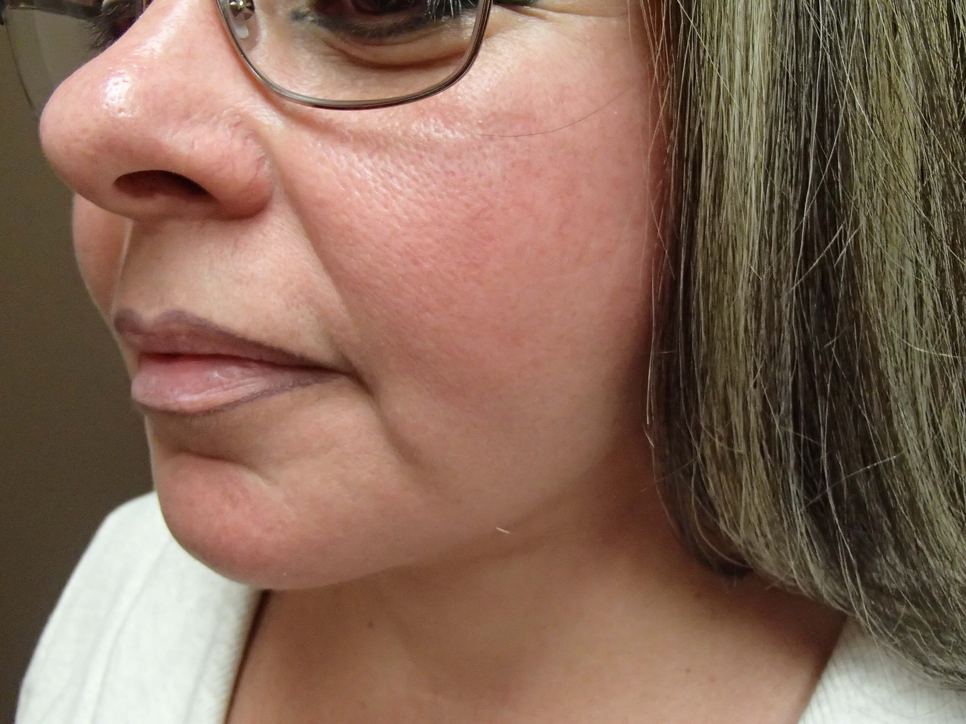 Necklift After