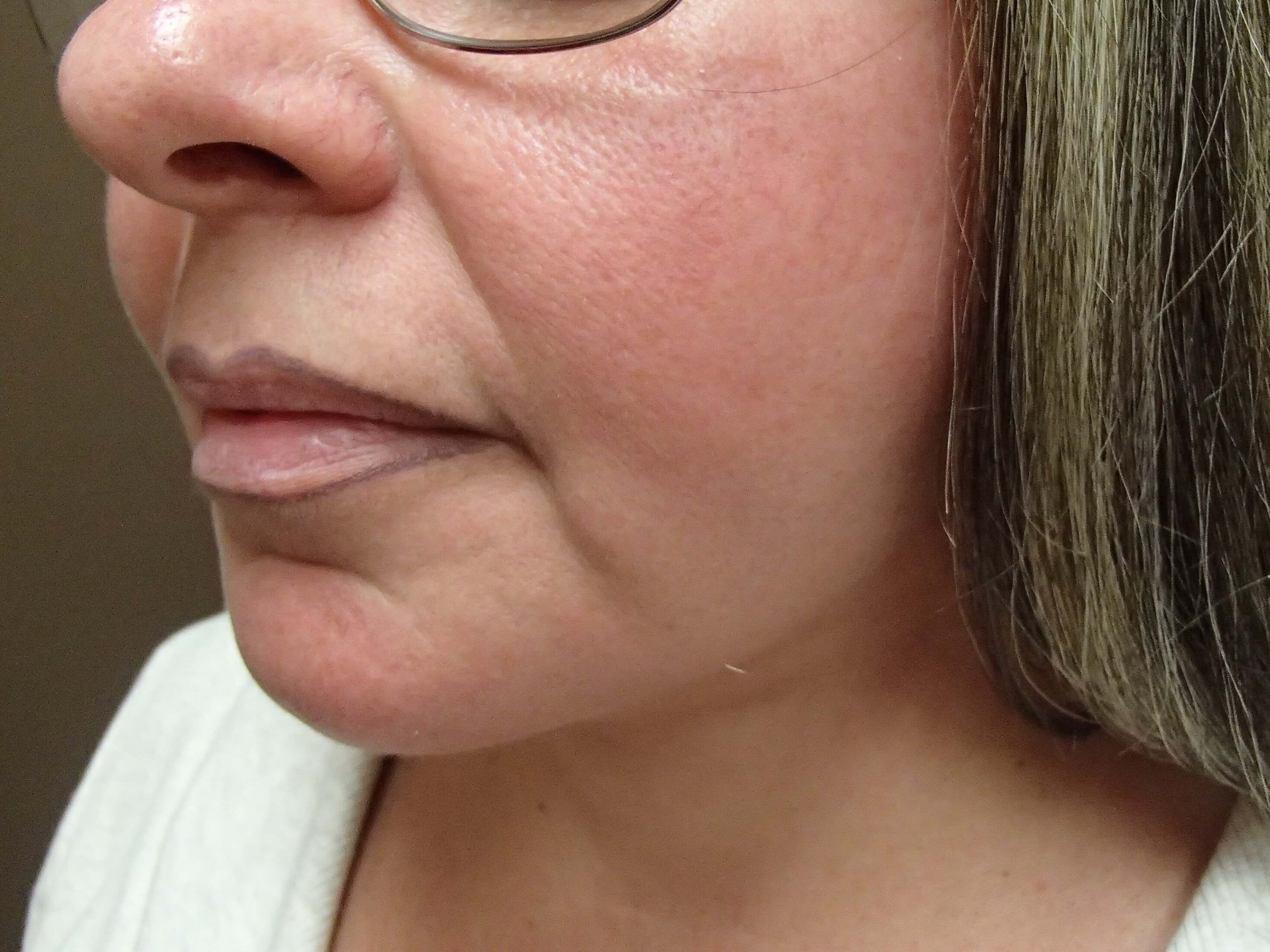 Necklift After