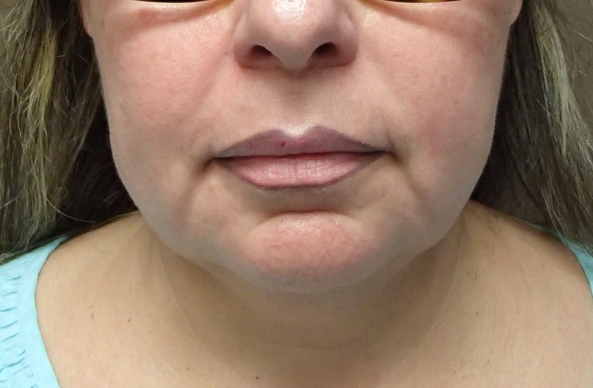Necklift Before