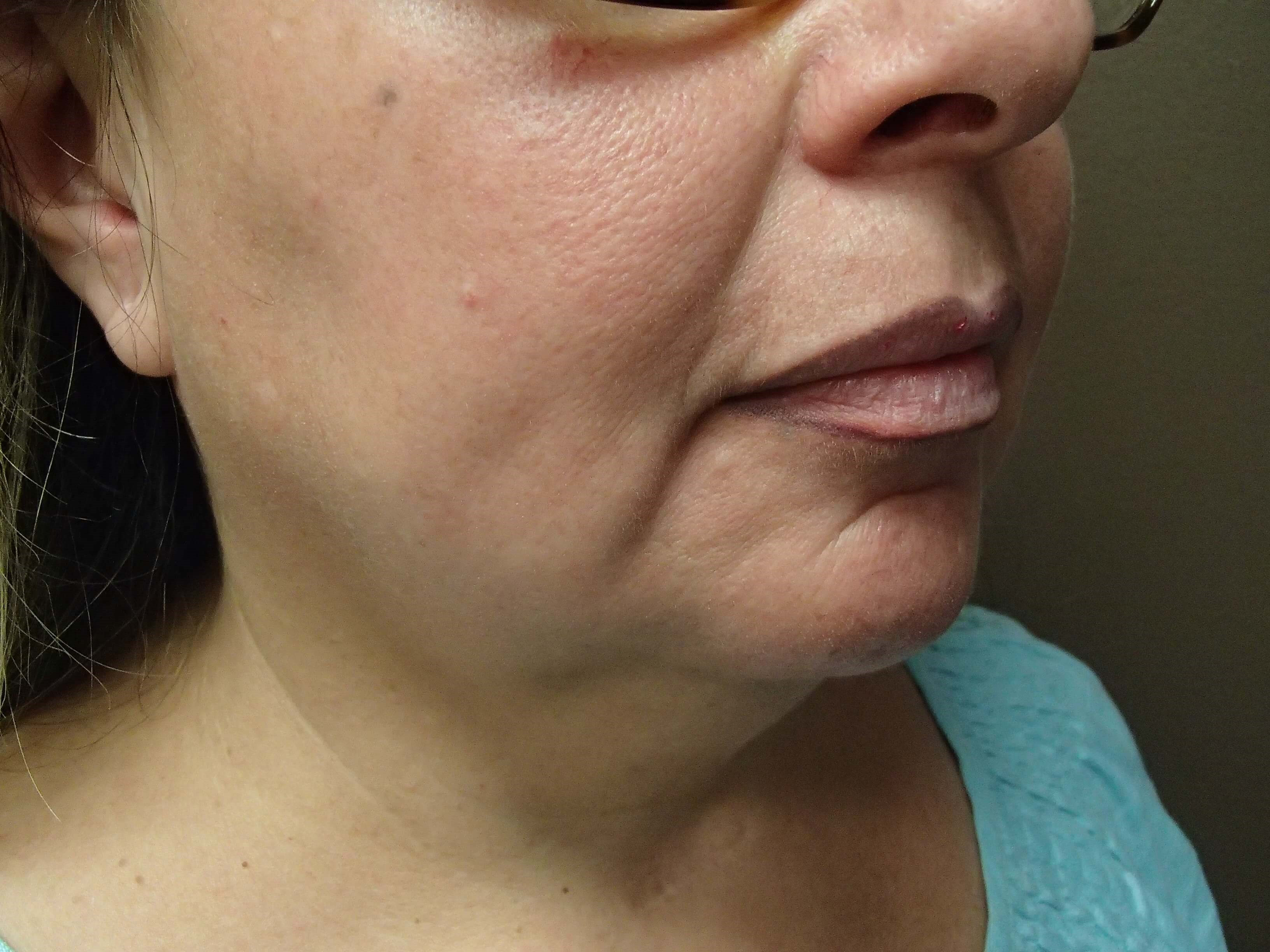 Necklift Before