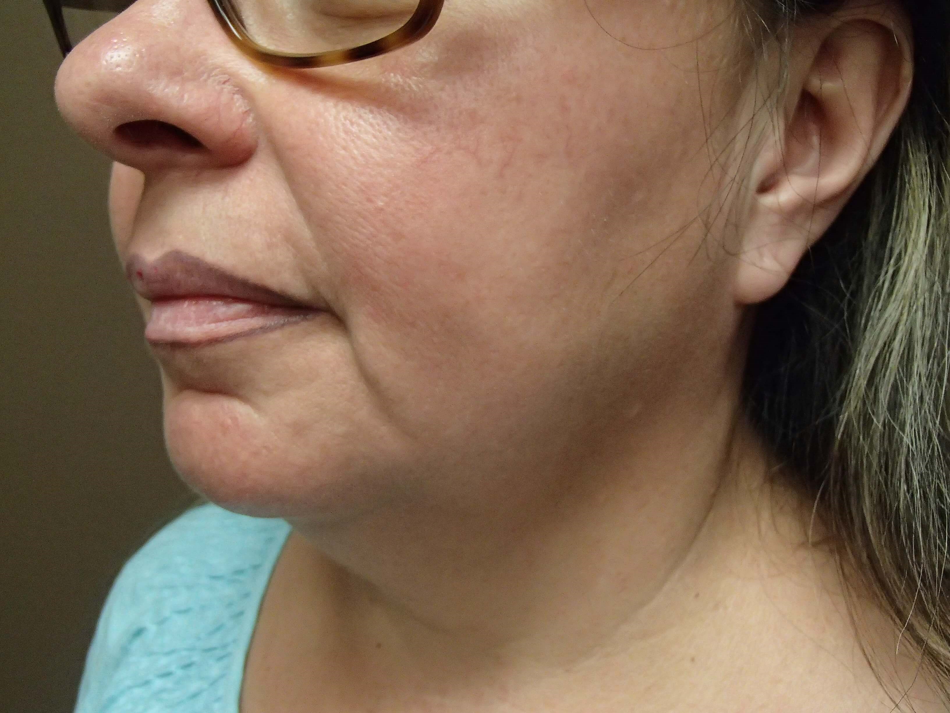 Necklift Before