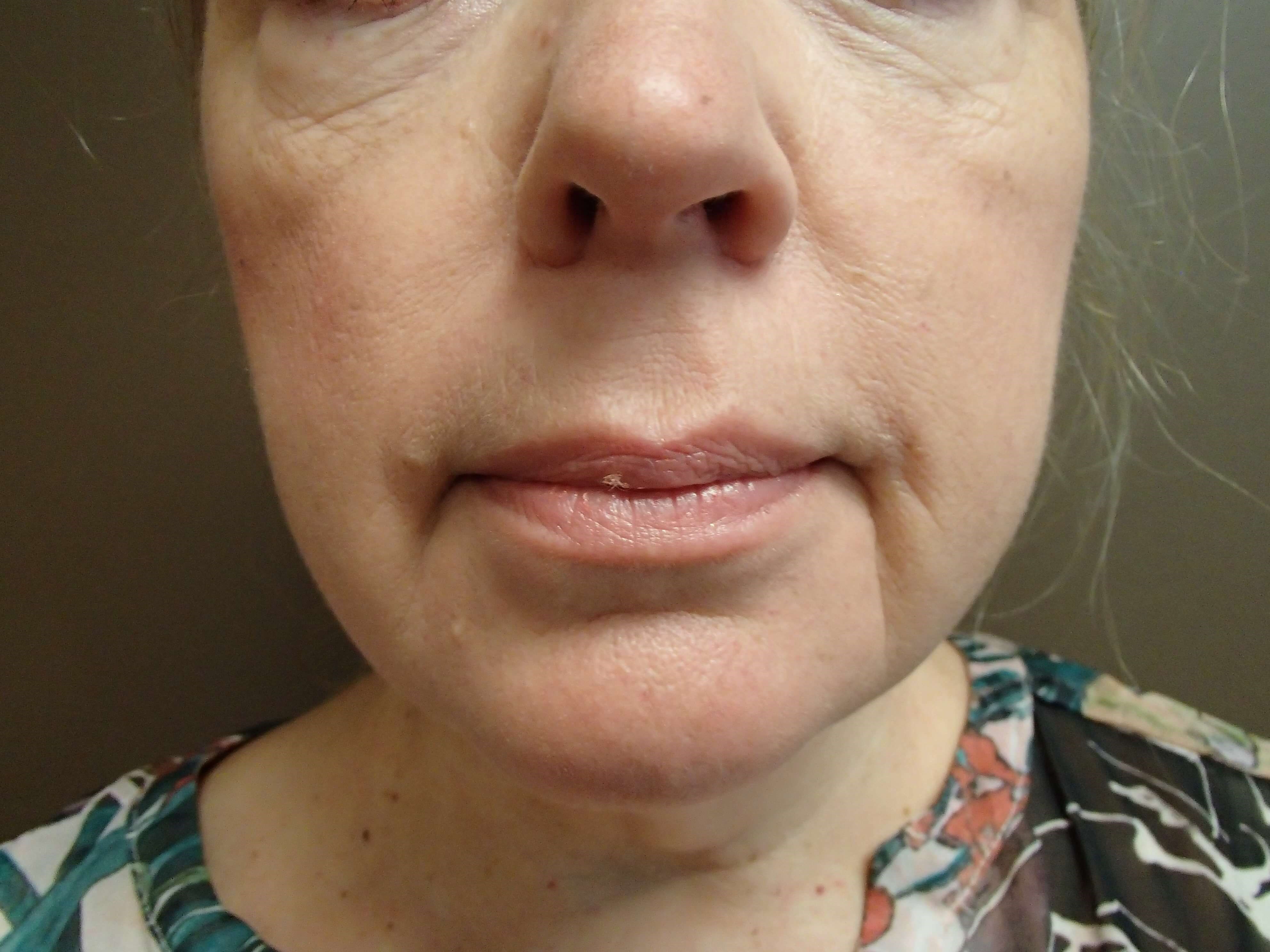 Necklift Before