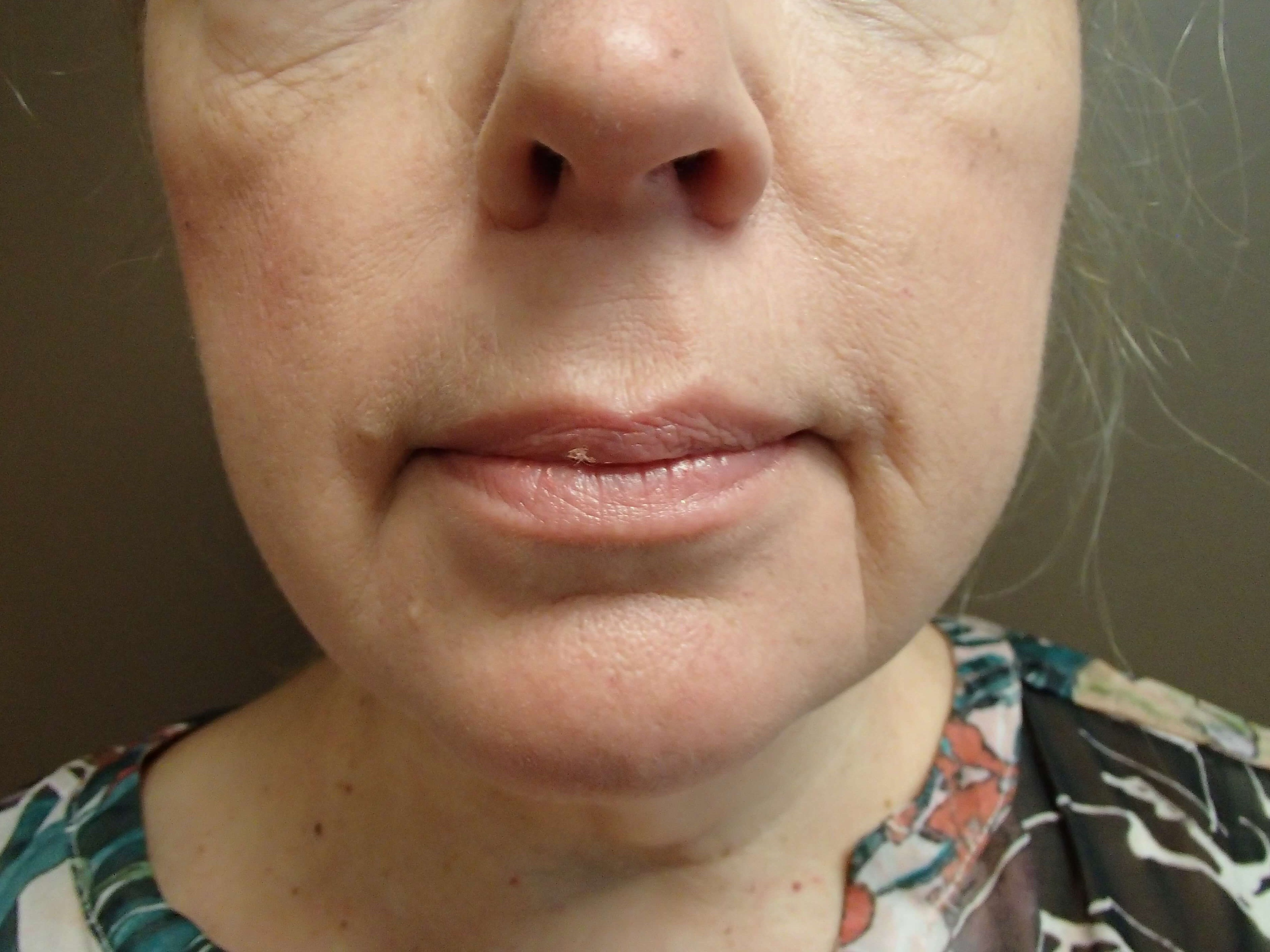 Necklift Before