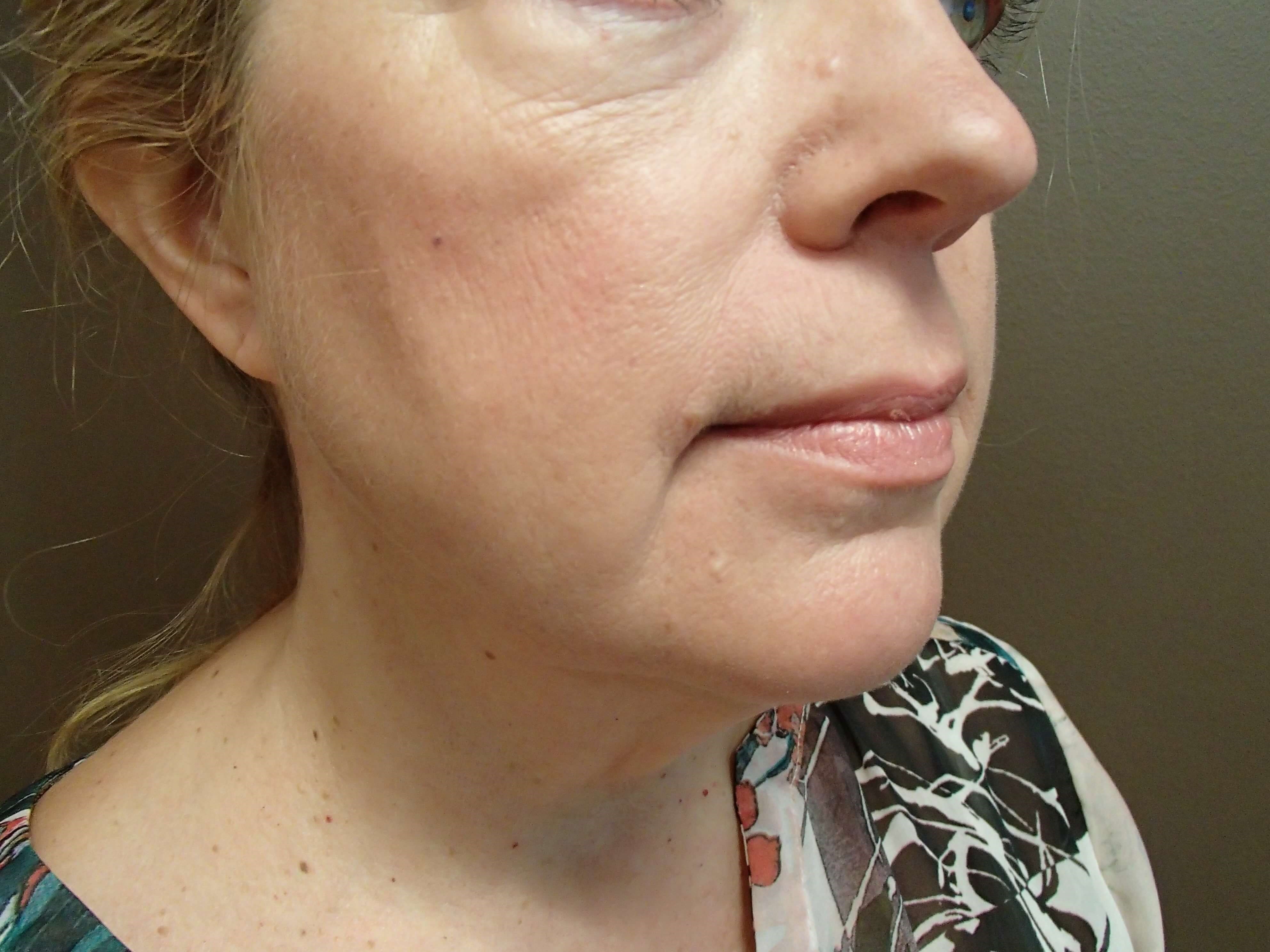 Necklift Before