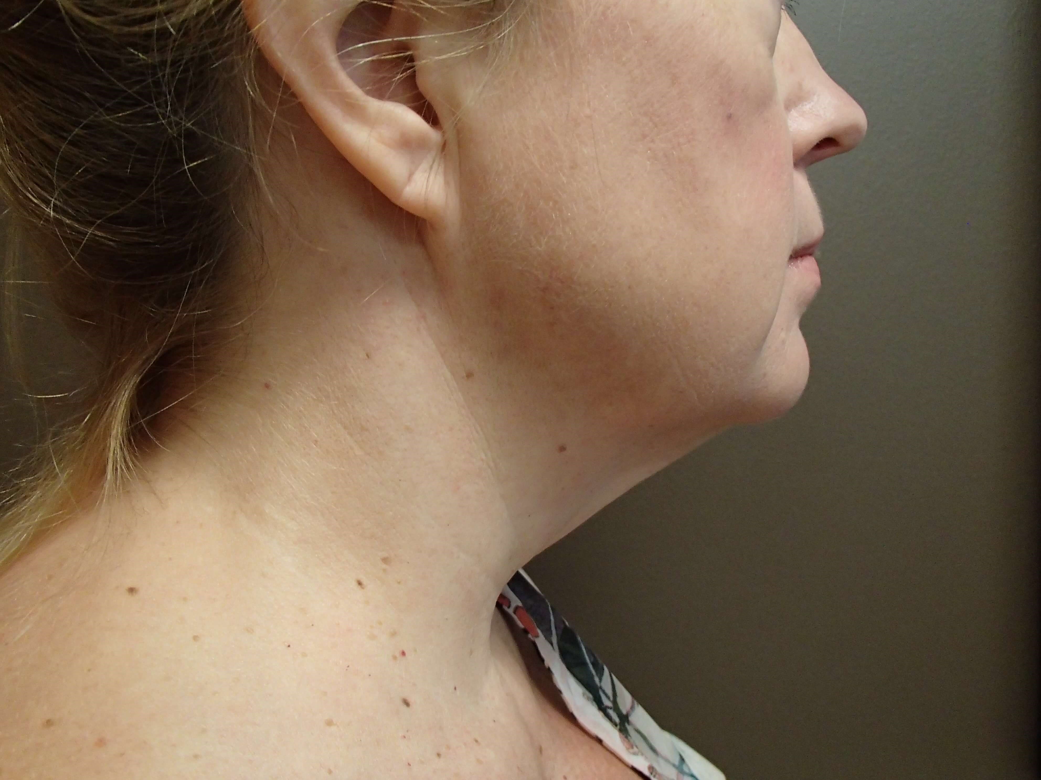 Necklift Before