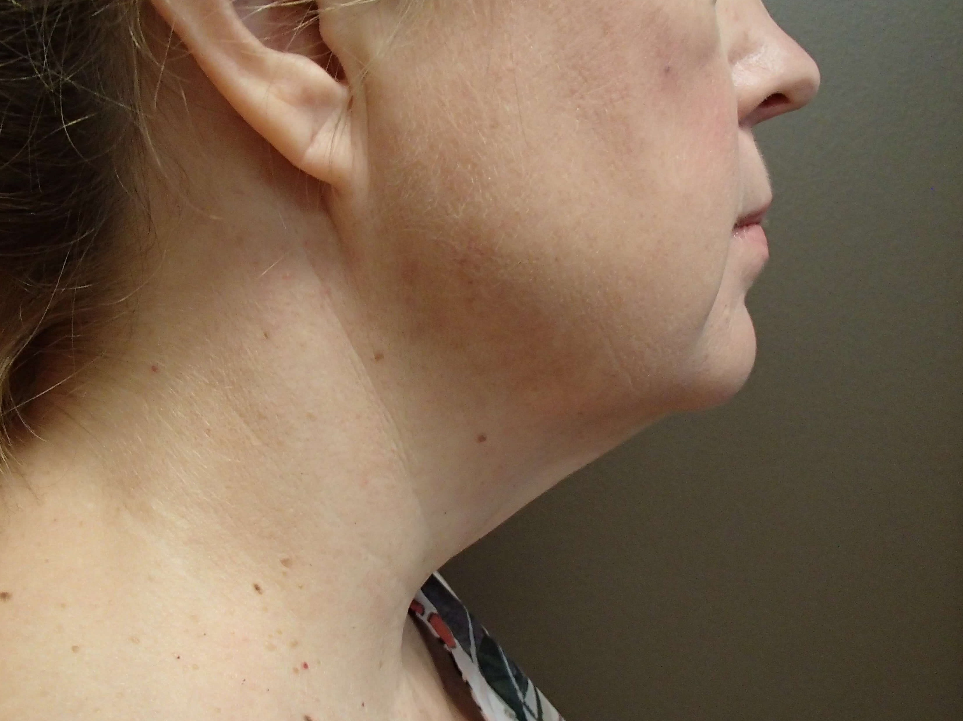 Necklift Before