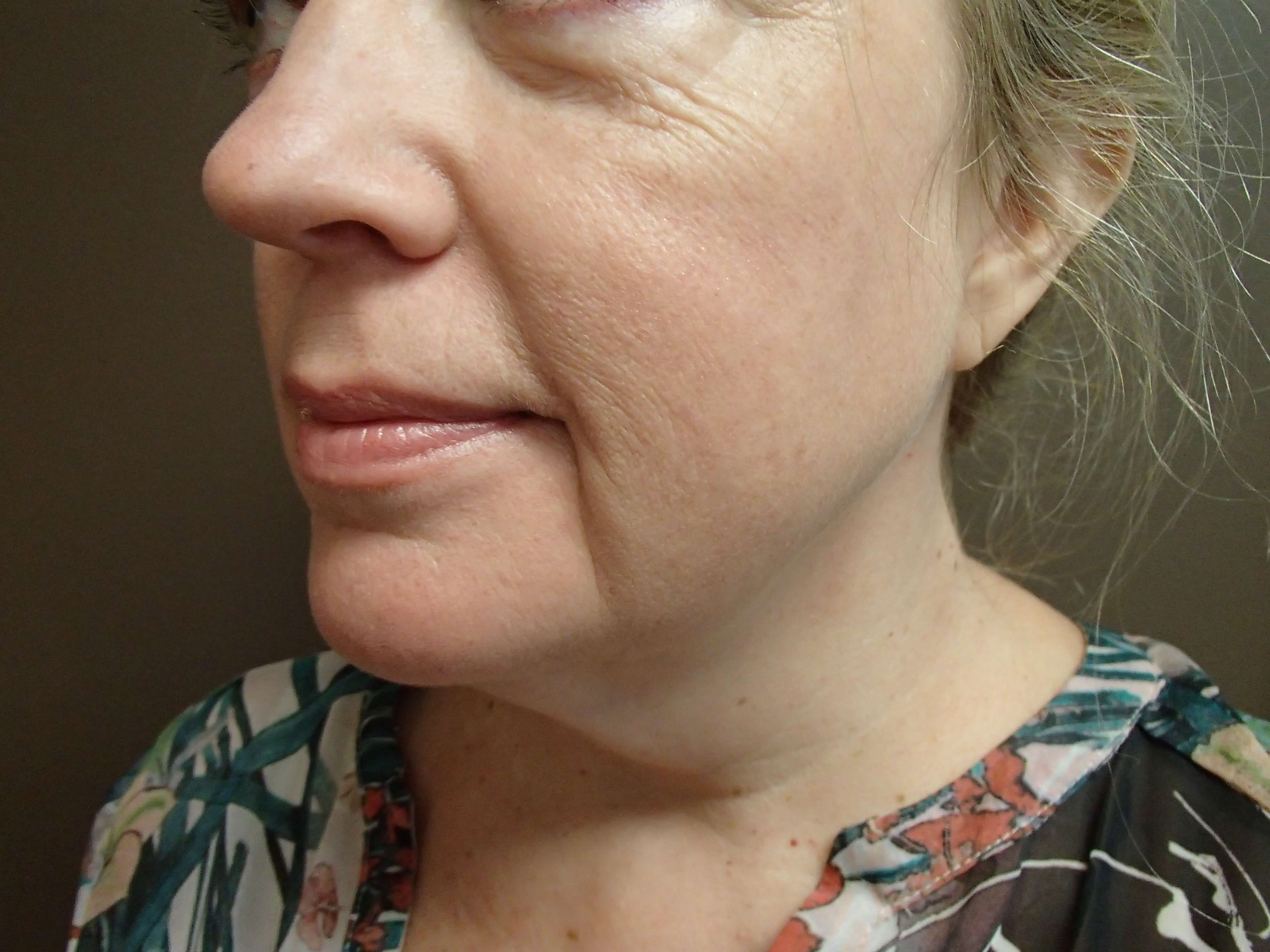 Necklift Before
