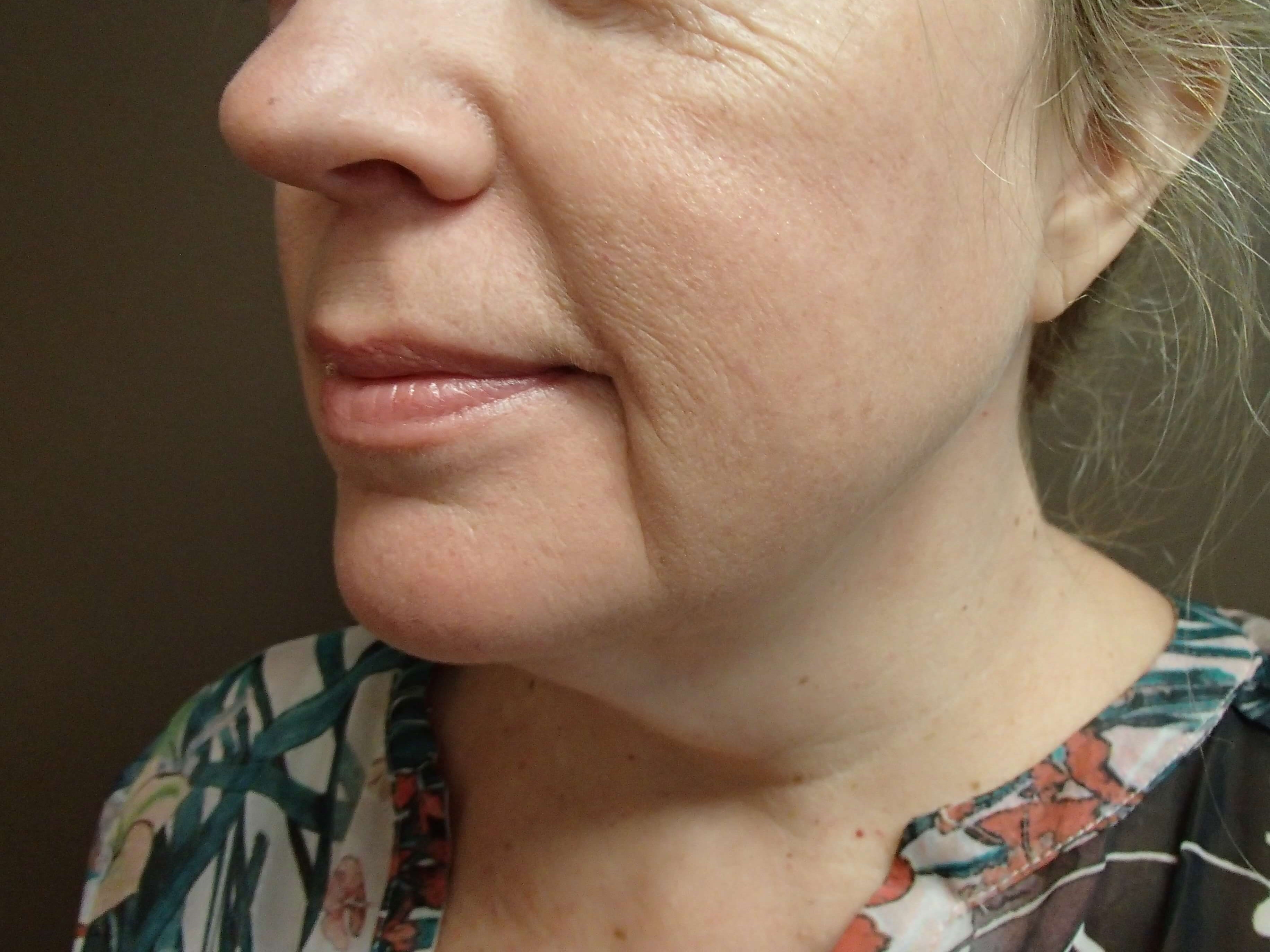 Necklift Before