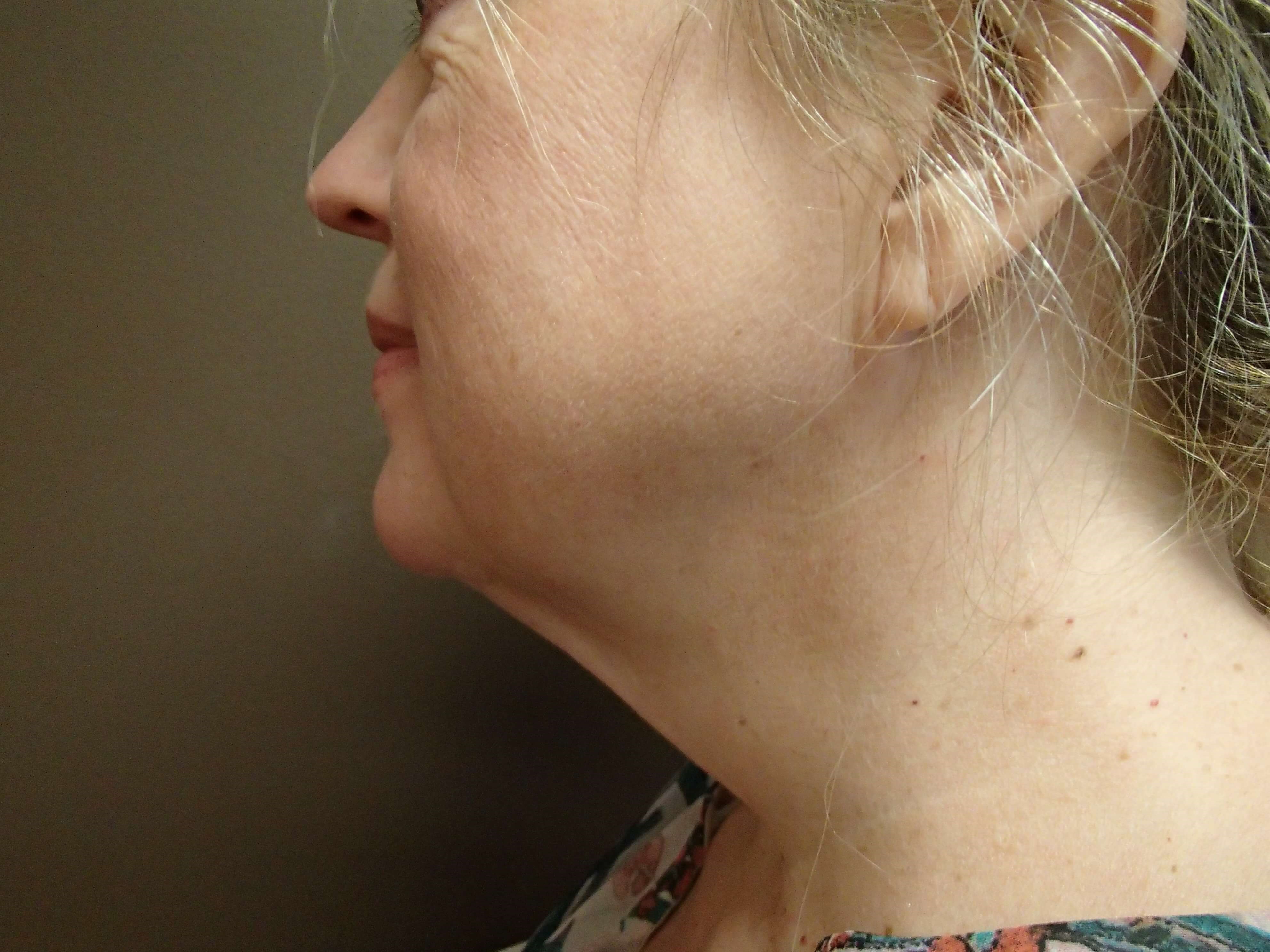 Necklift Before