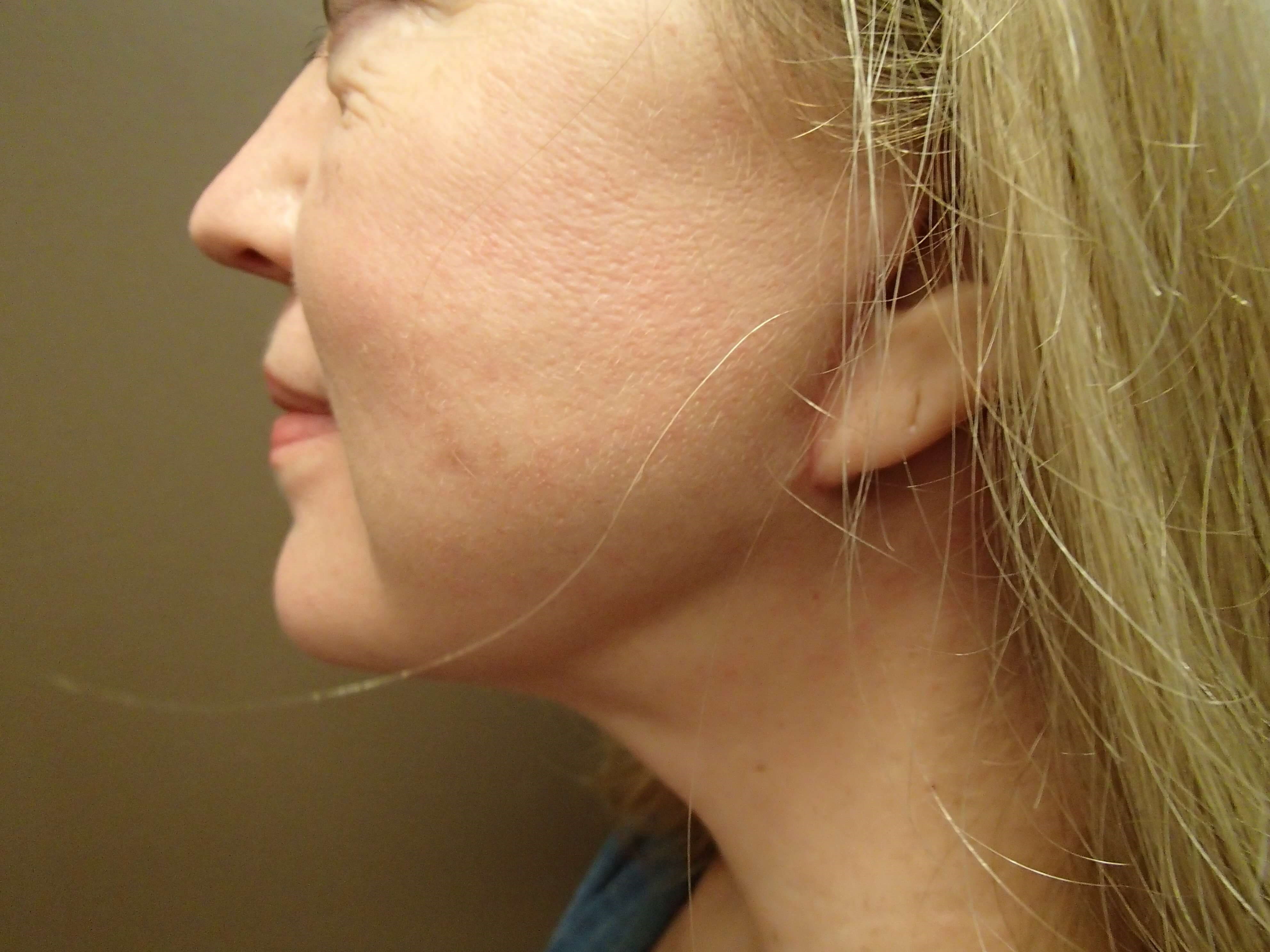 Necklift After