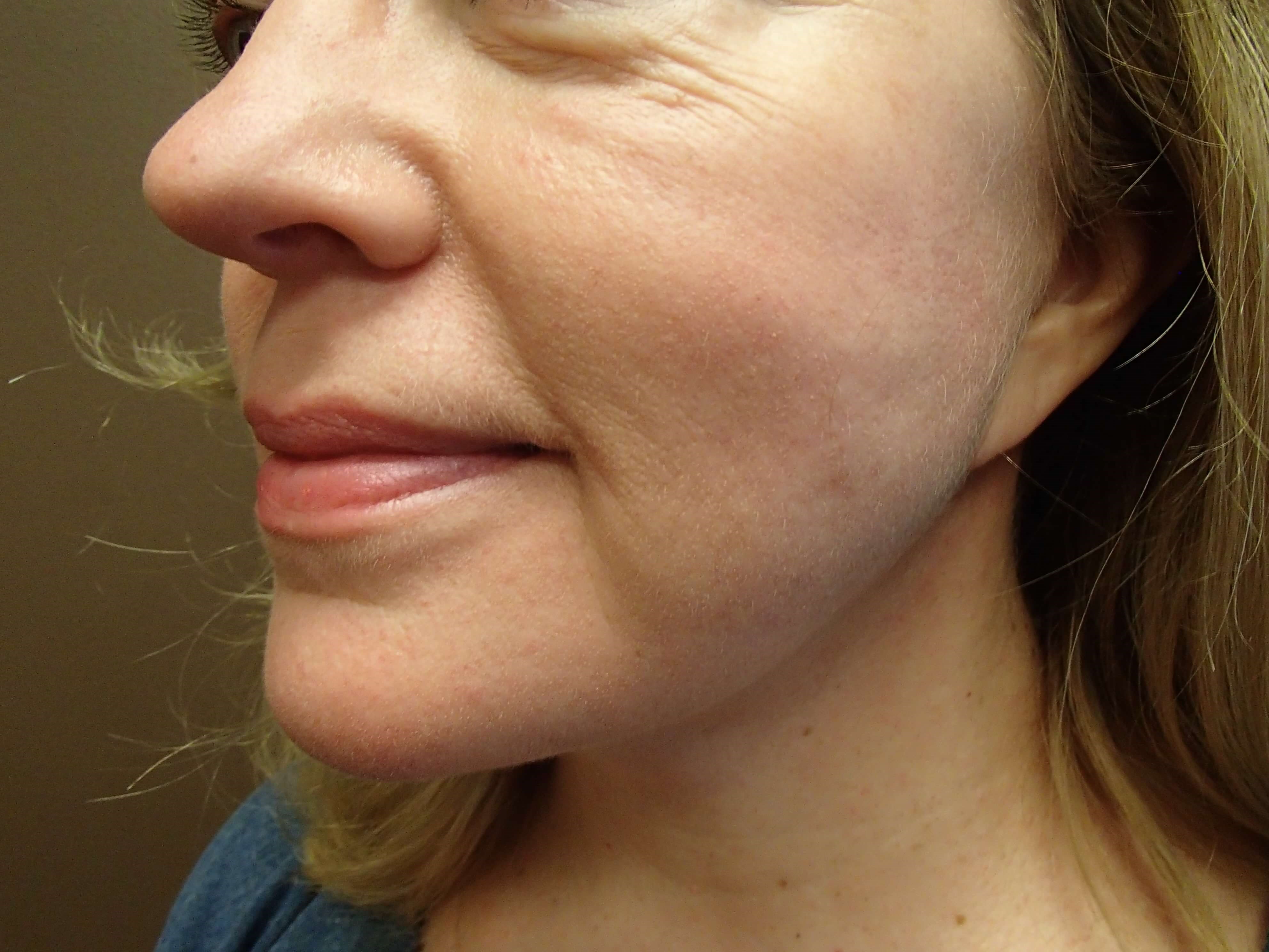 Necklift After