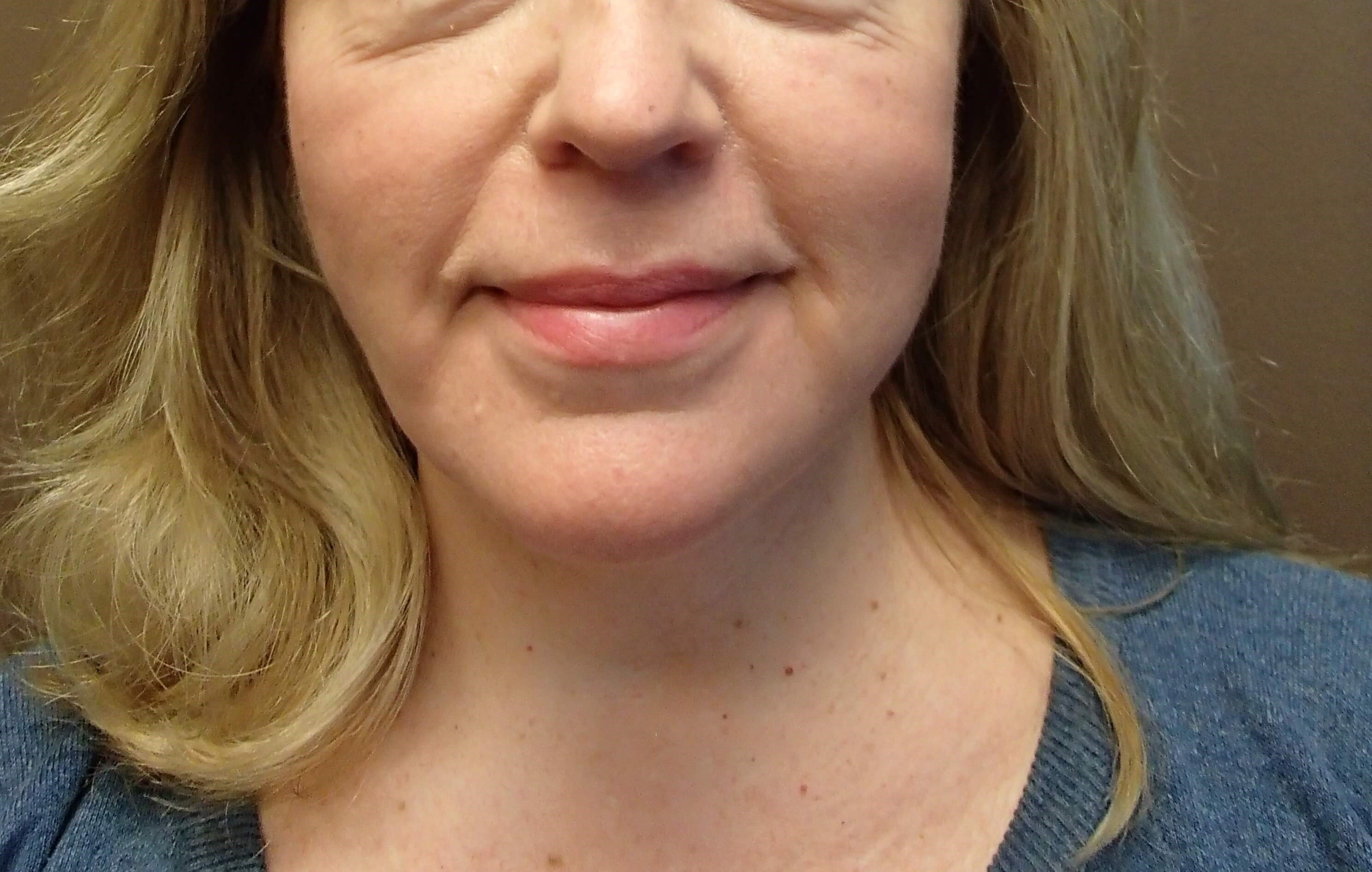 Necklift After