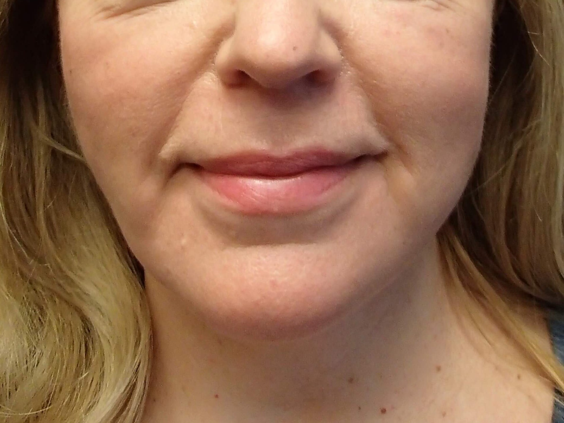Necklift After