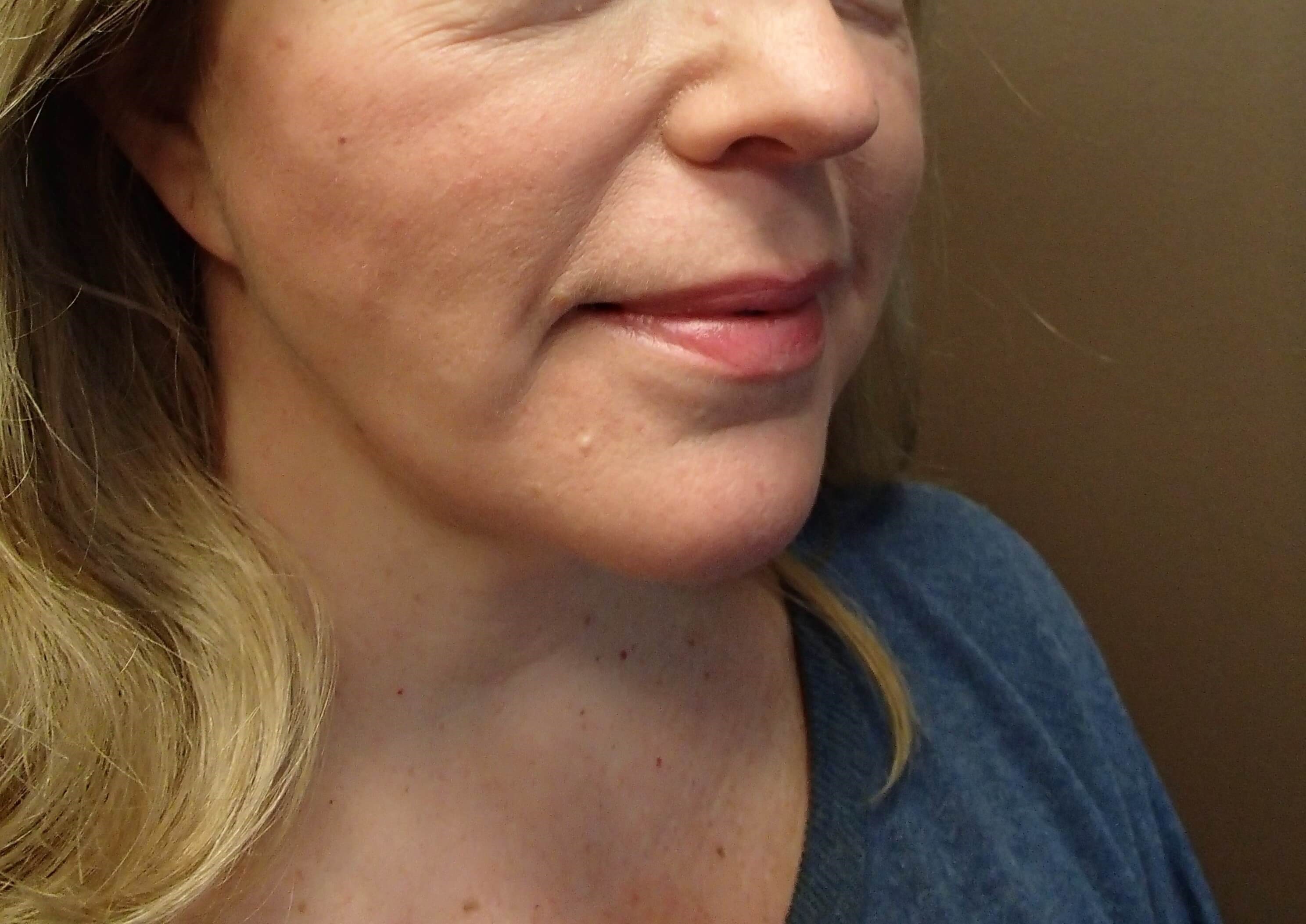 Necklift After
