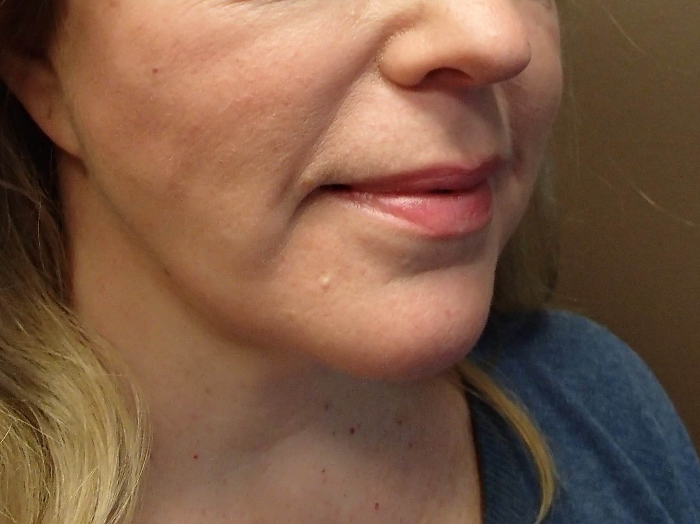 Necklift After