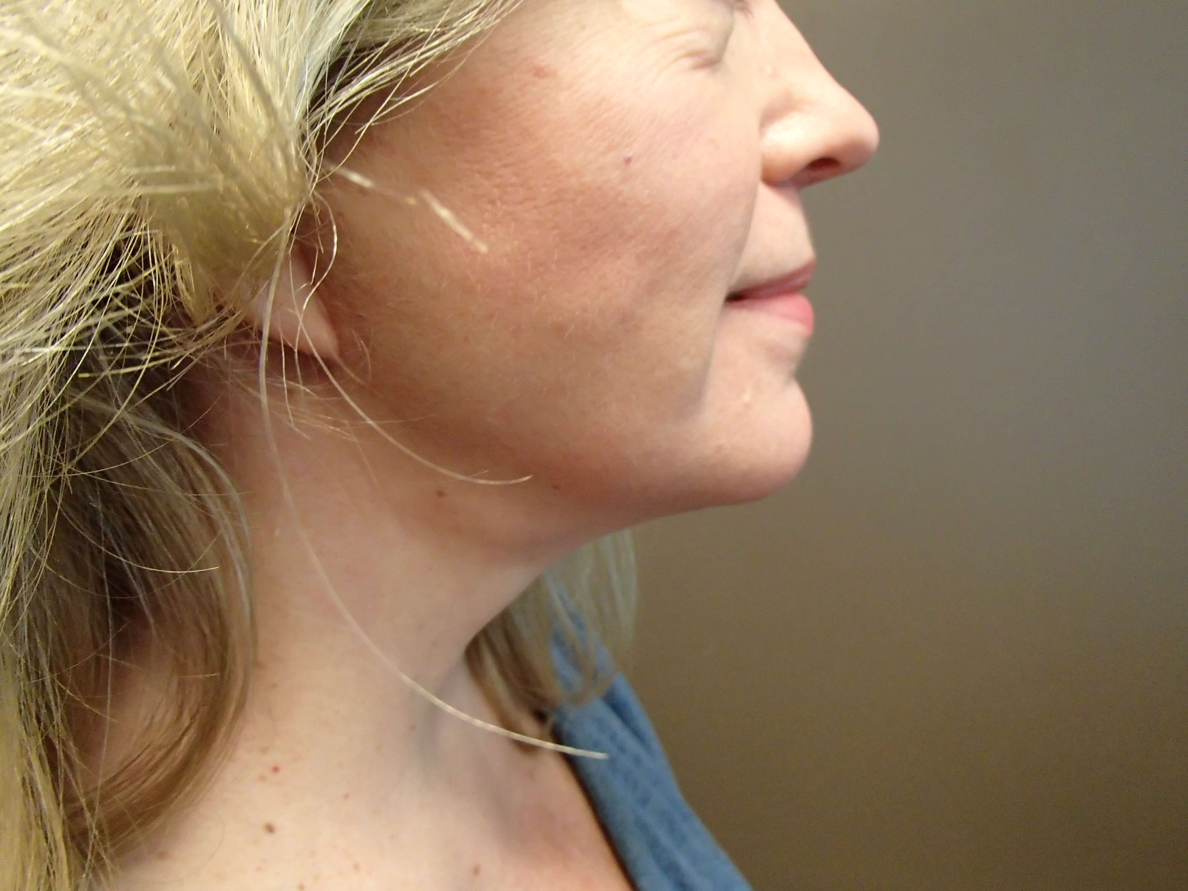 Necklift After