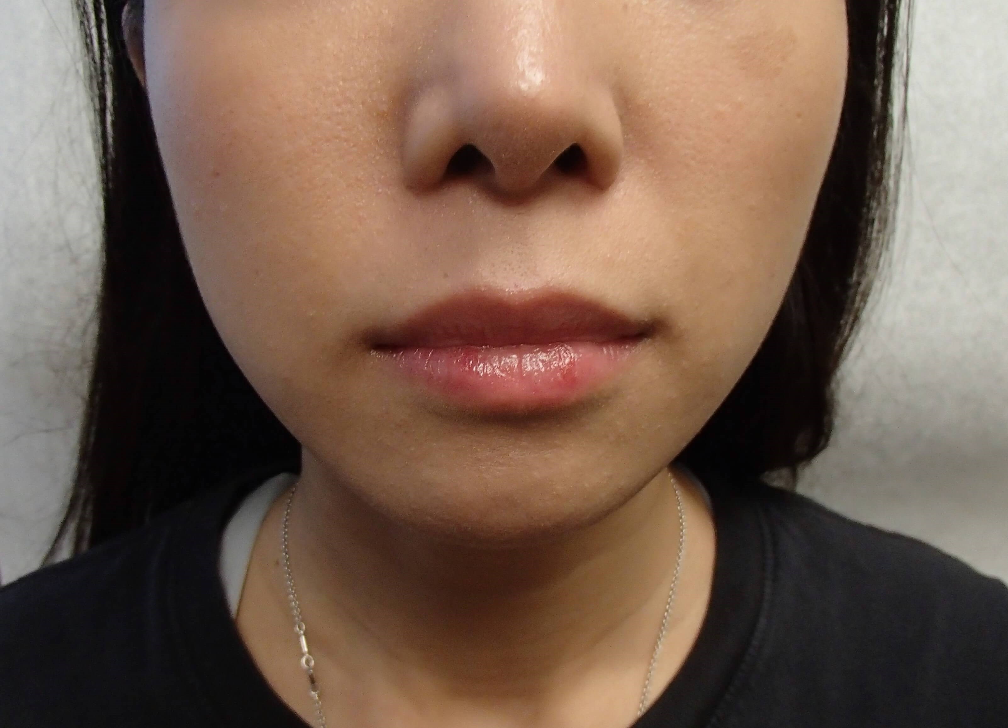 Buccal Fat Pad Removal After