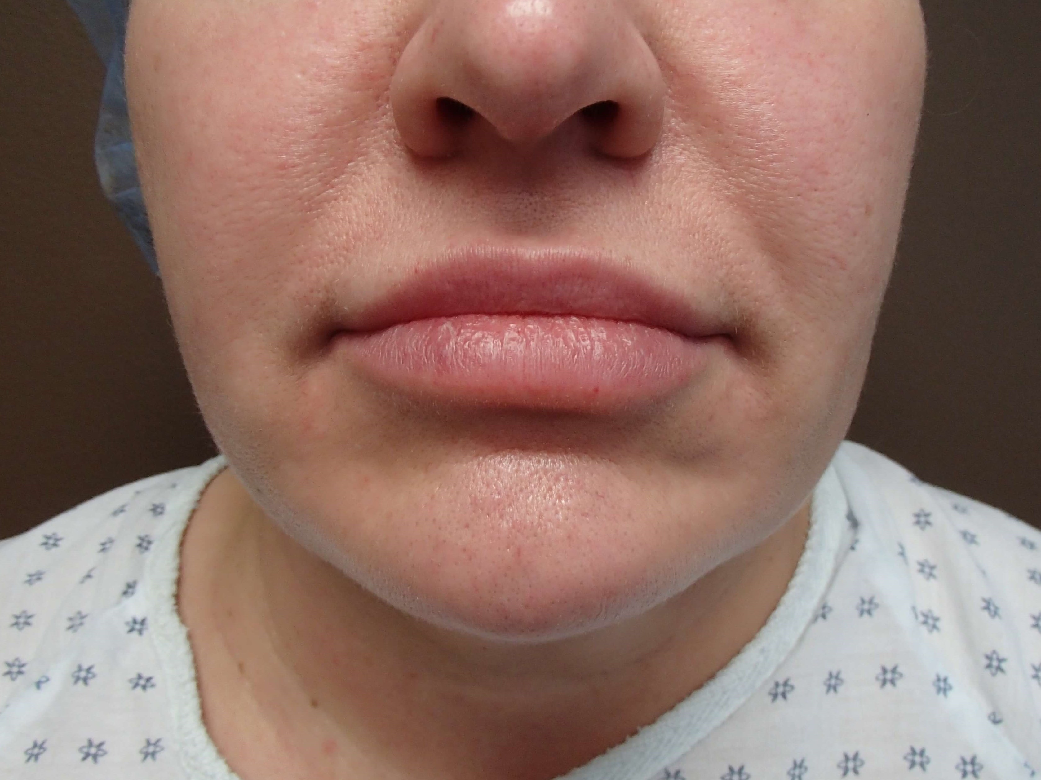 Buccal Fat Pad Removal Before