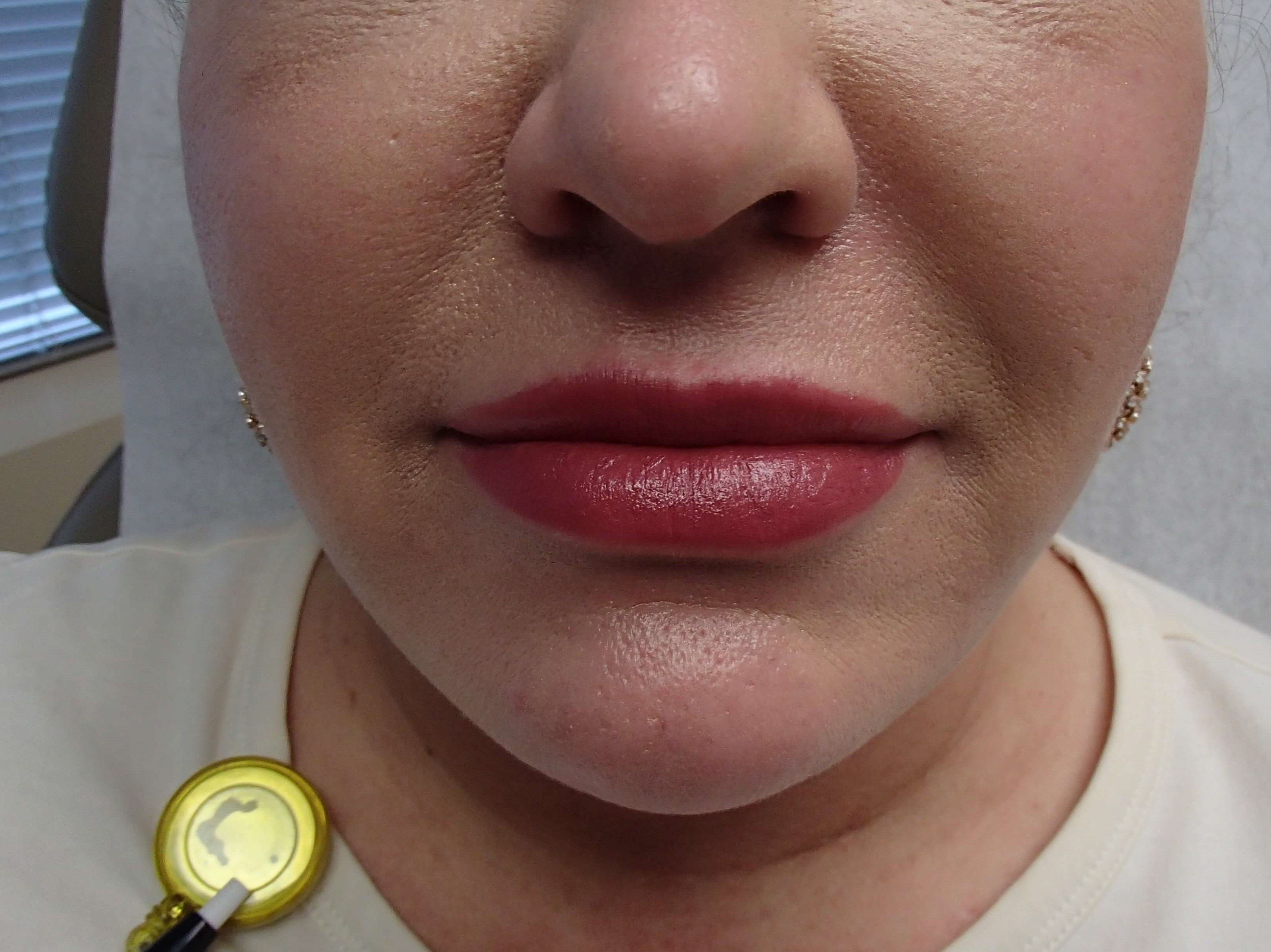 Buccal Fat Pad Removal After