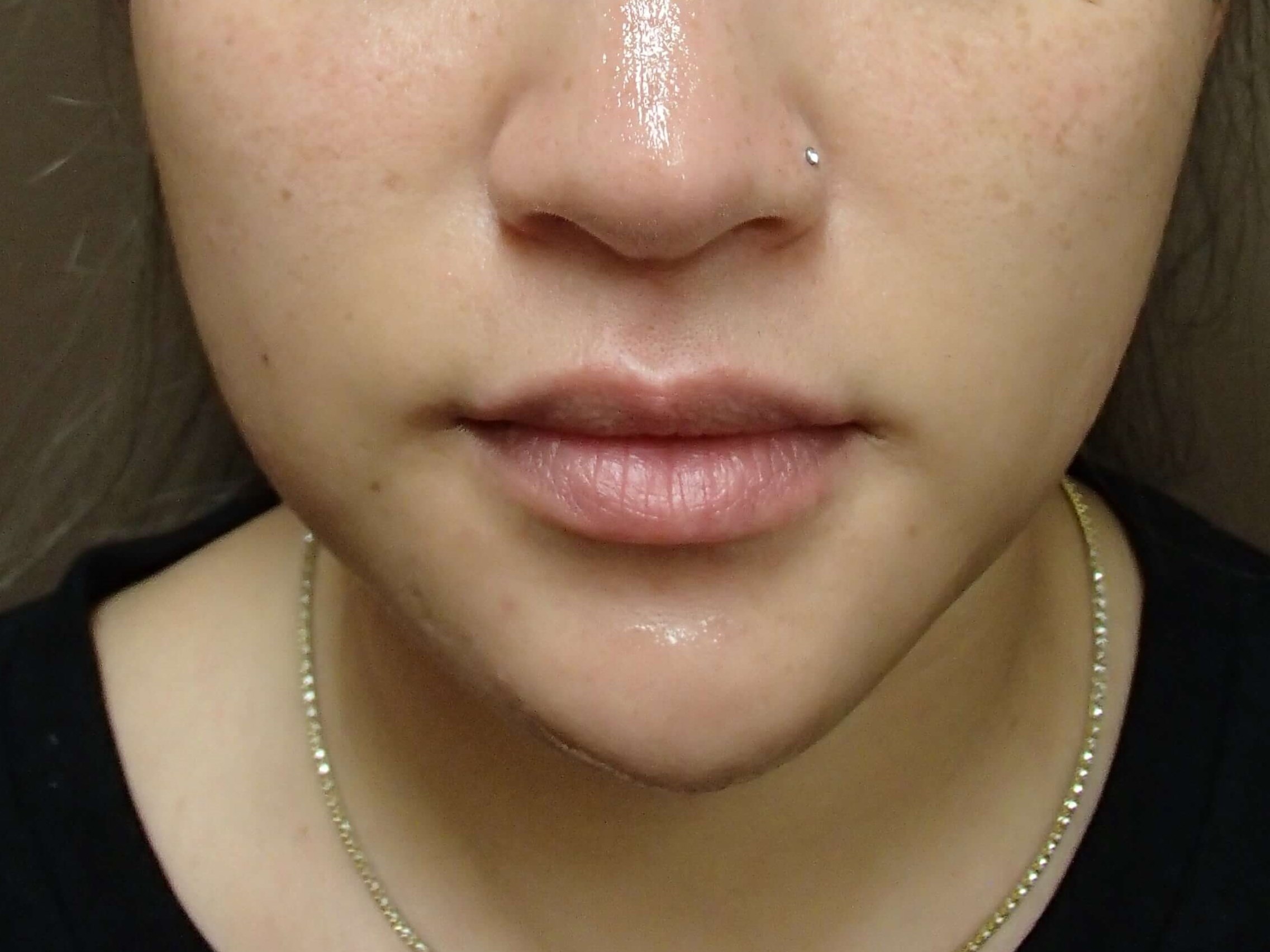 Buccal Fat Pad Removal After