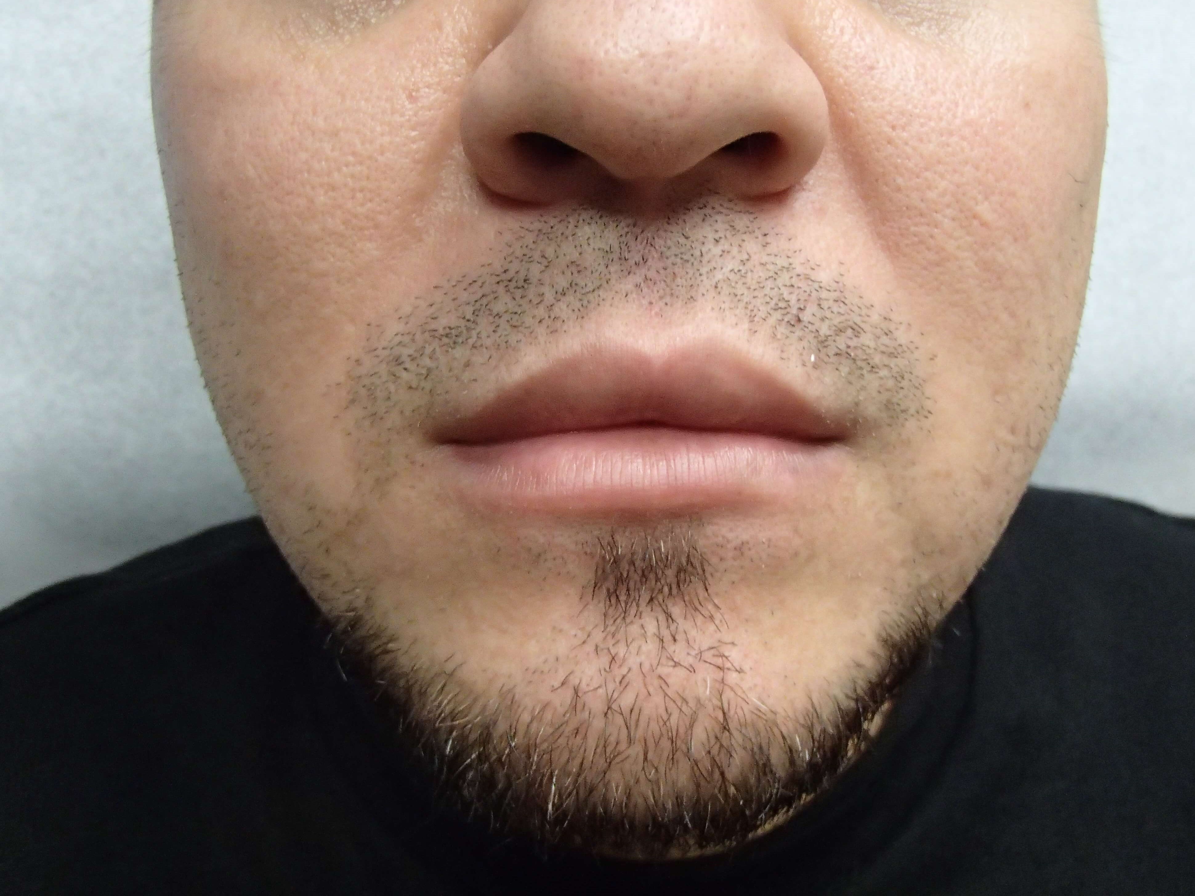 Buccal Fat Pad Removal Before