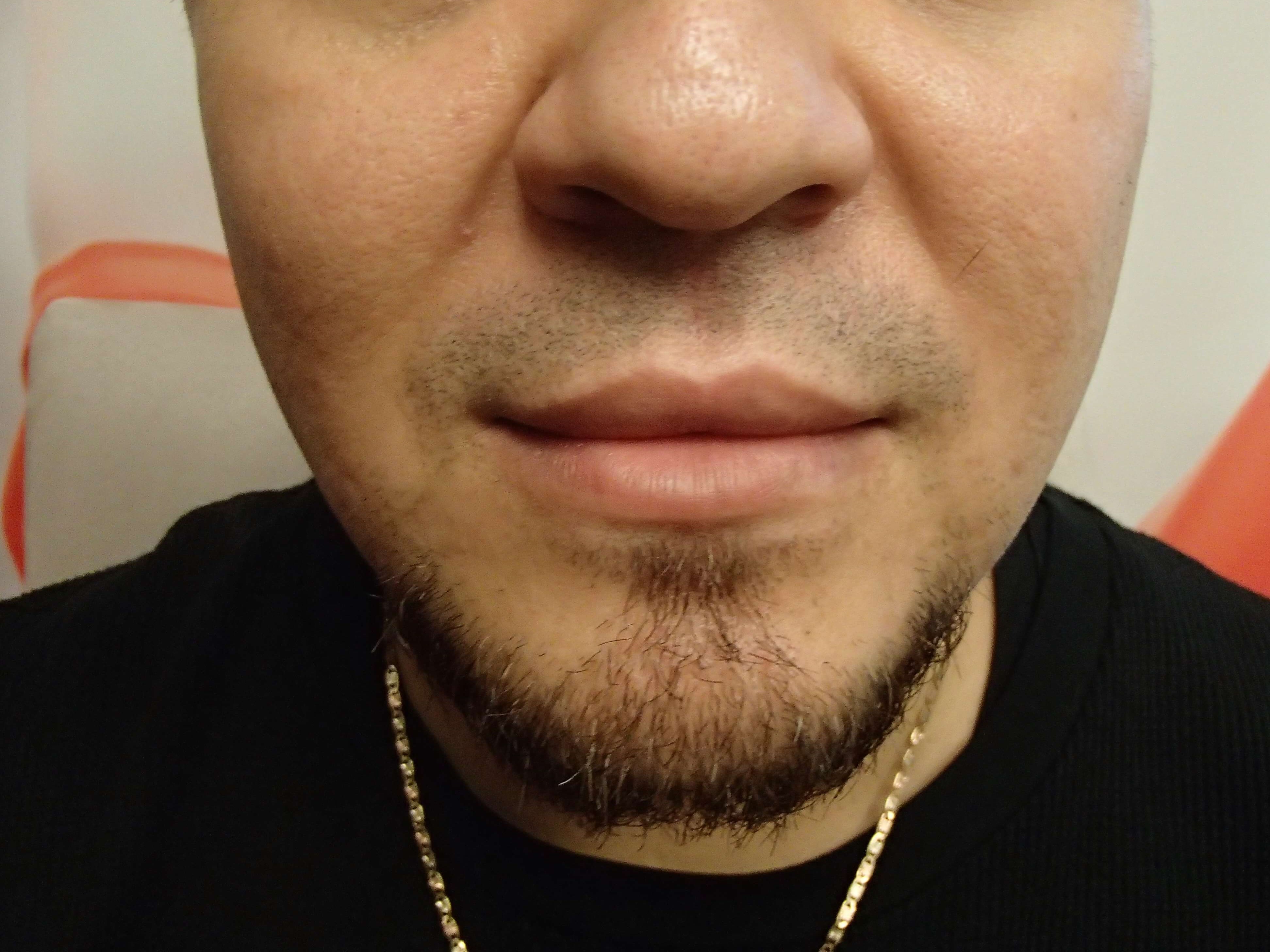 Buccal Fat Pad Removal After